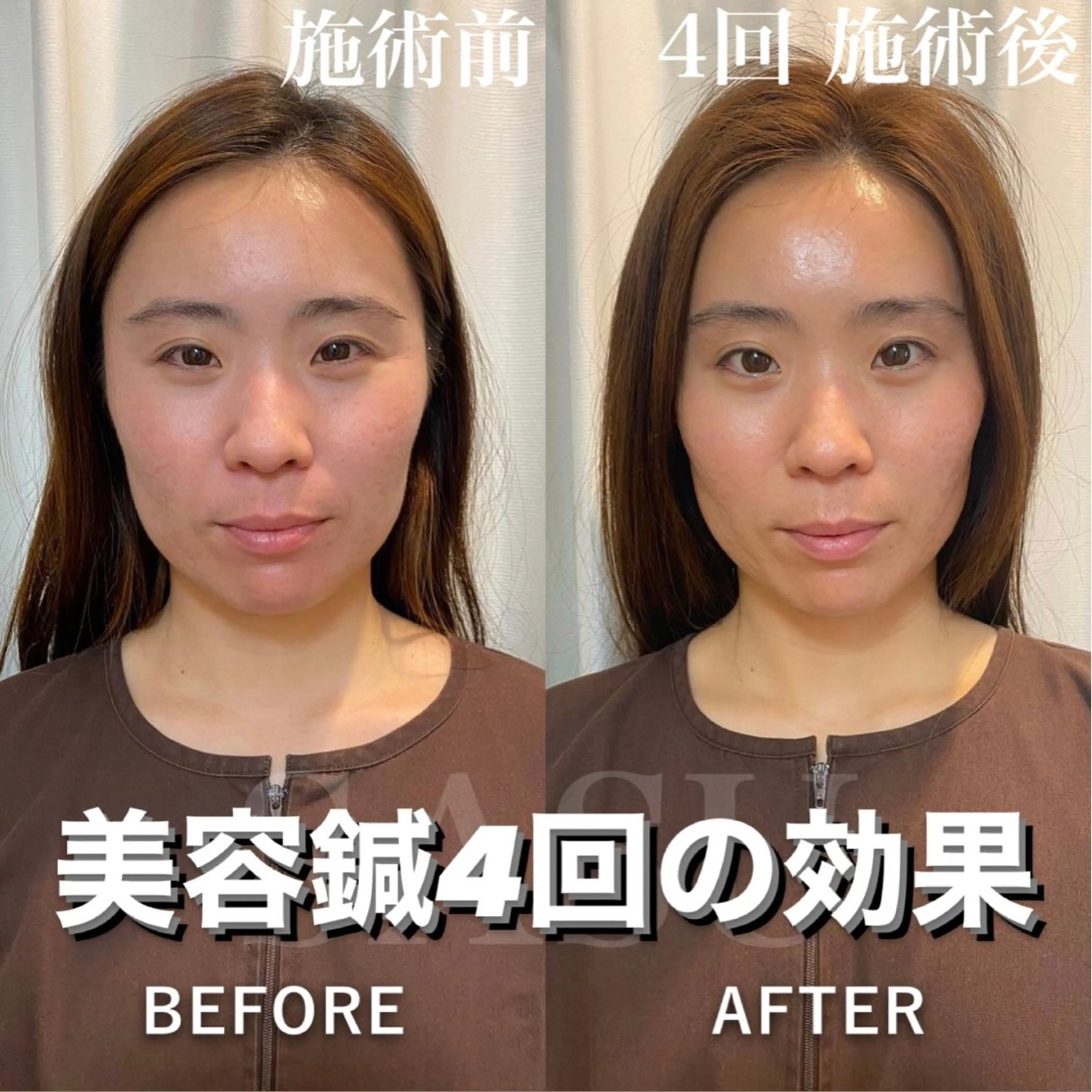 その他 鍼灸×ハーブピーリングサロンSASU所属・石井 稚乃のその他イメージ