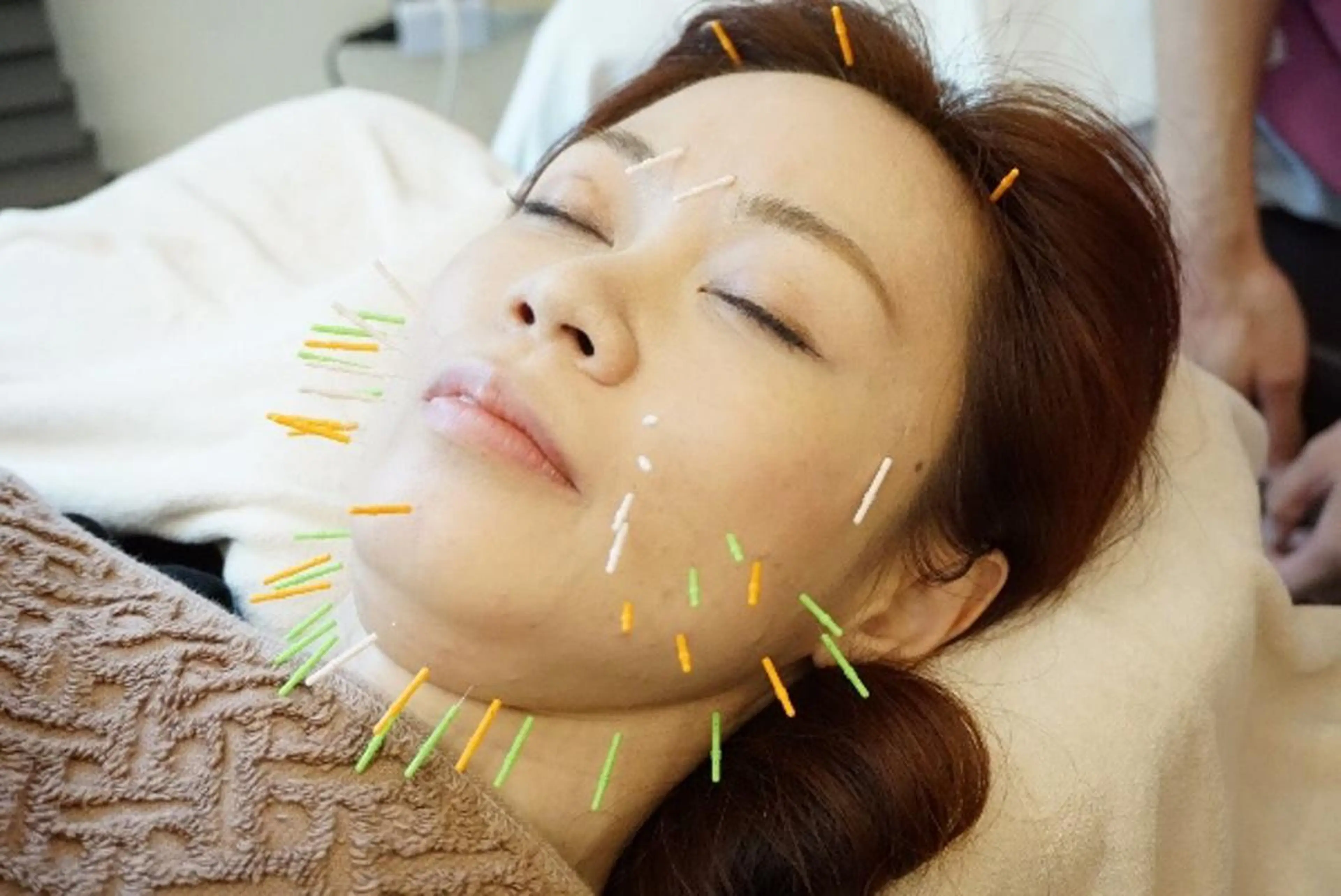 人気1位🥇💄Body&Cosmetic special 美容鍼💄スペシャル美容鍼×全身施術の写真