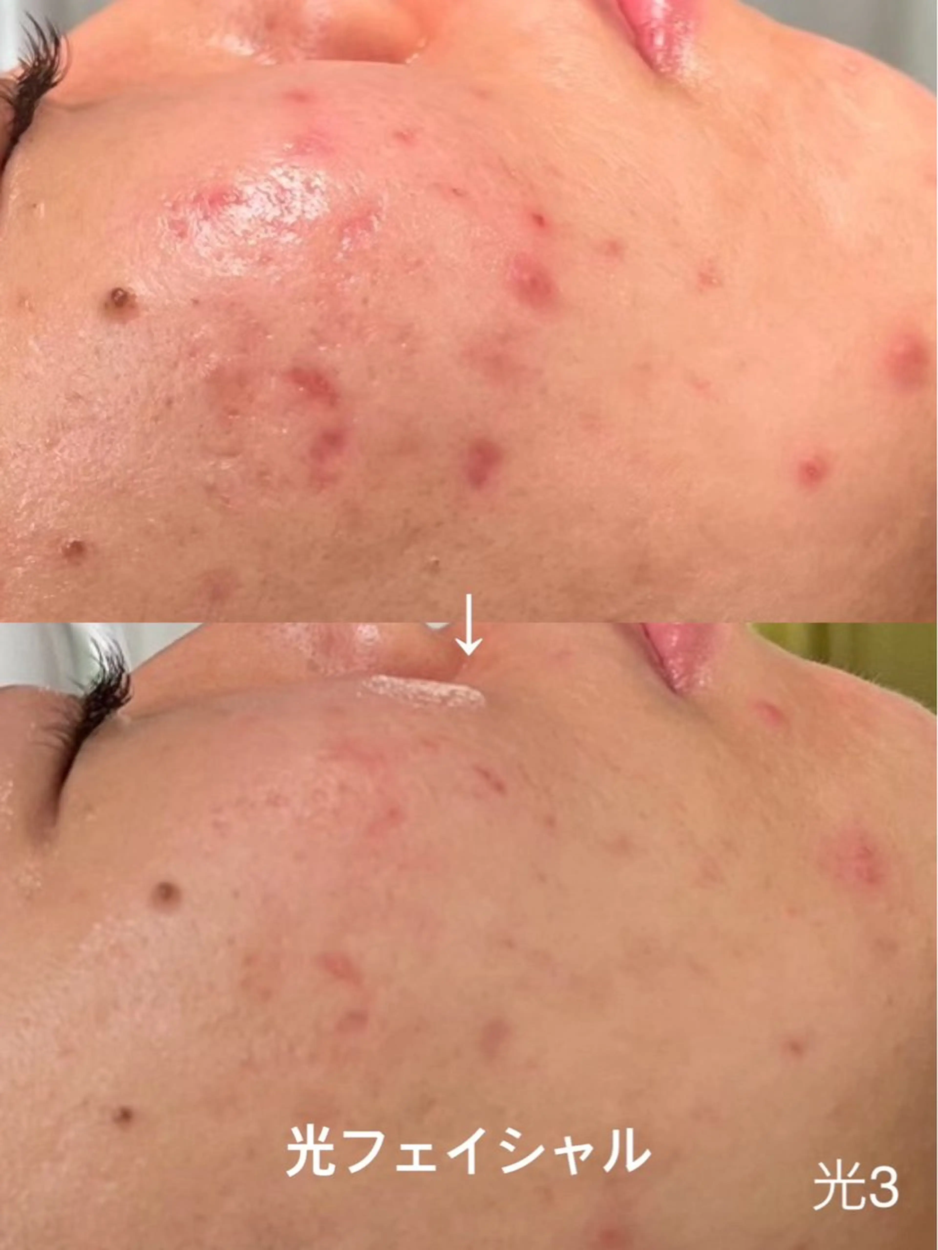 光フェイシャル｜赤み・ニキビ跡・くすみの写真