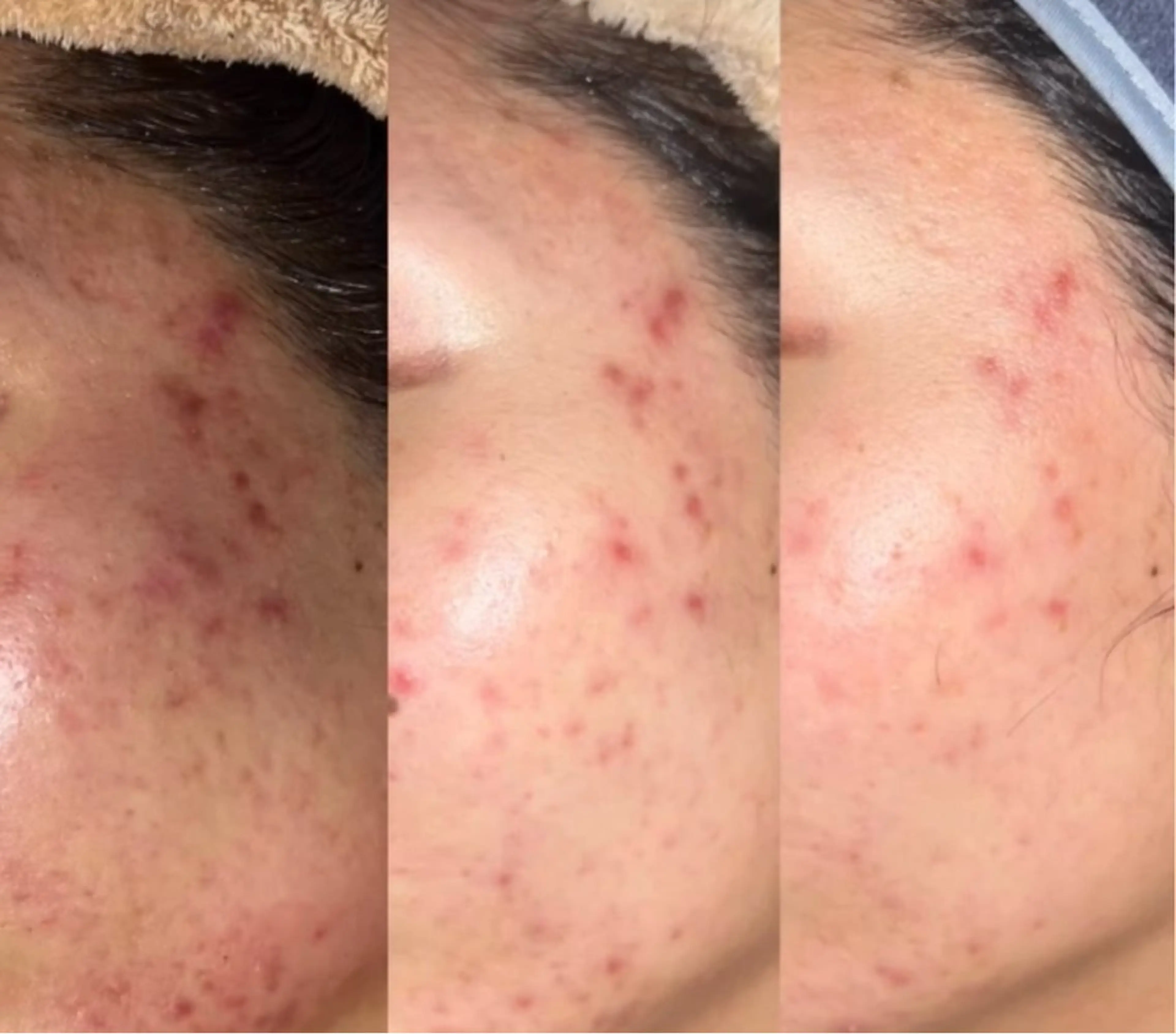 肌質改善コース🥰ハーブピーリング🌿肌荒れ・ニキビ肌・クレーター肌⭐️の写真