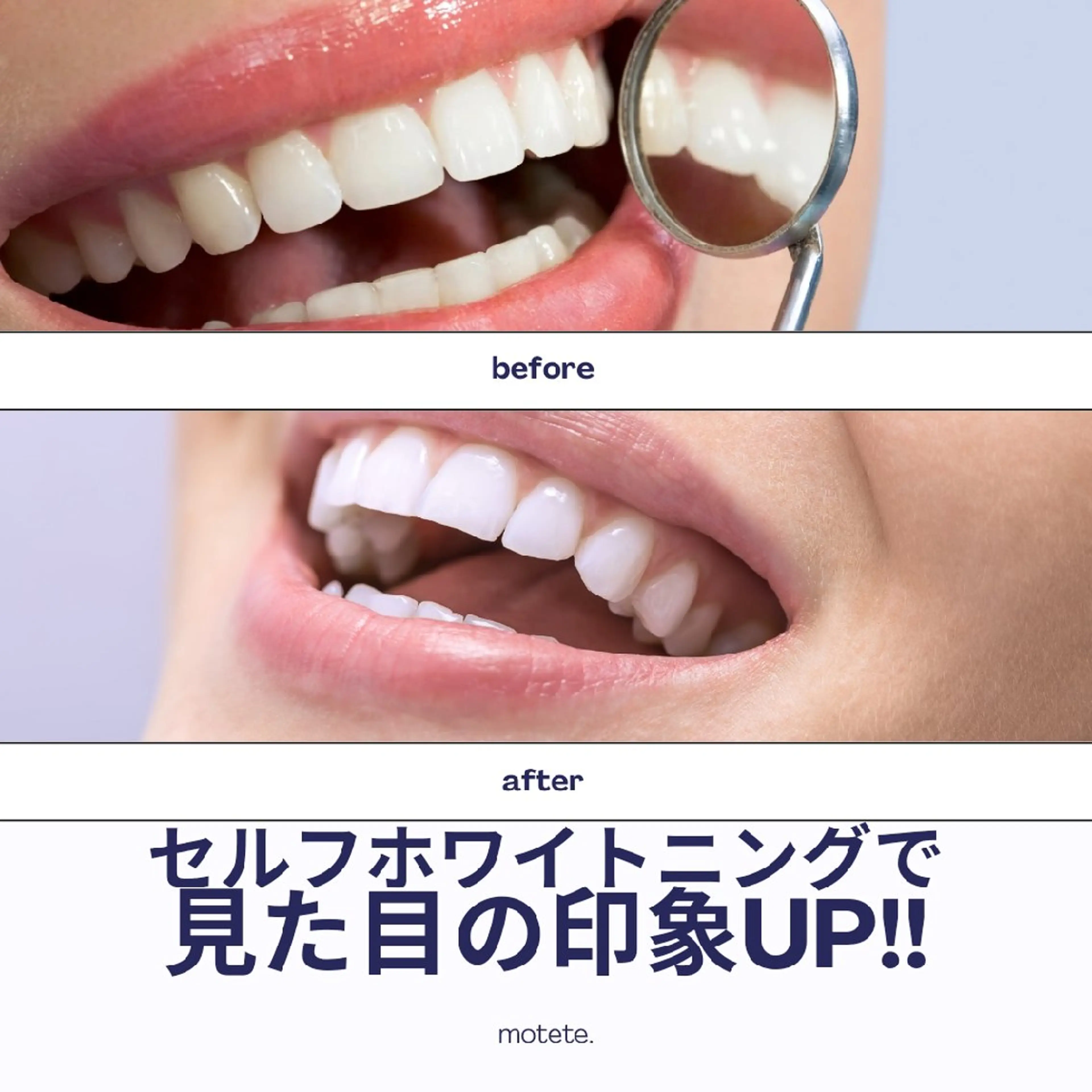 ブライダル☆🦷歯磨き不要☆セルフホワイトニング60分¥4980の写真