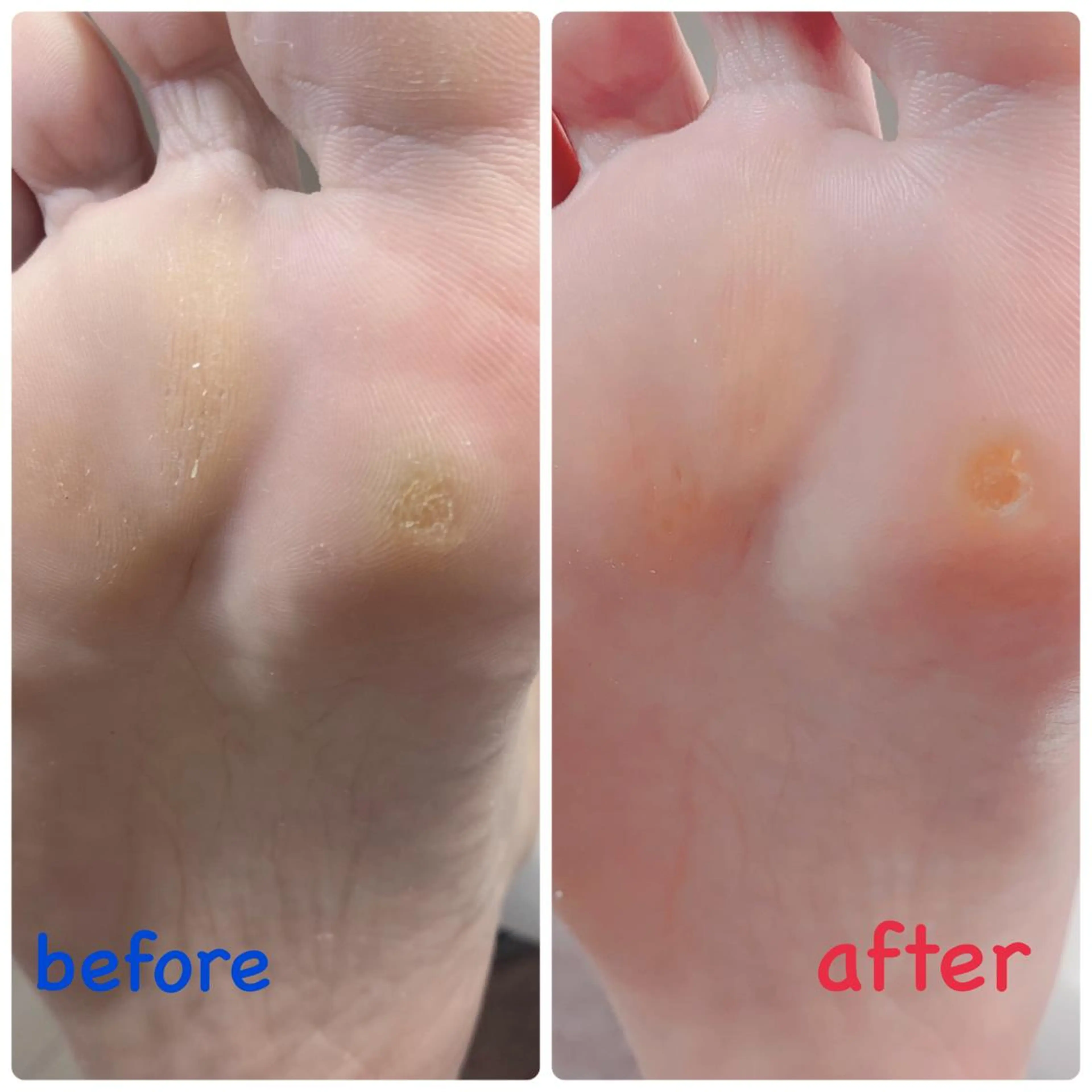 フット★①＆②お得なセット★足裏パック＆角質ケア＆お爪周りのケア＆爪切り＆マッサージ（フットバス付き）の写真