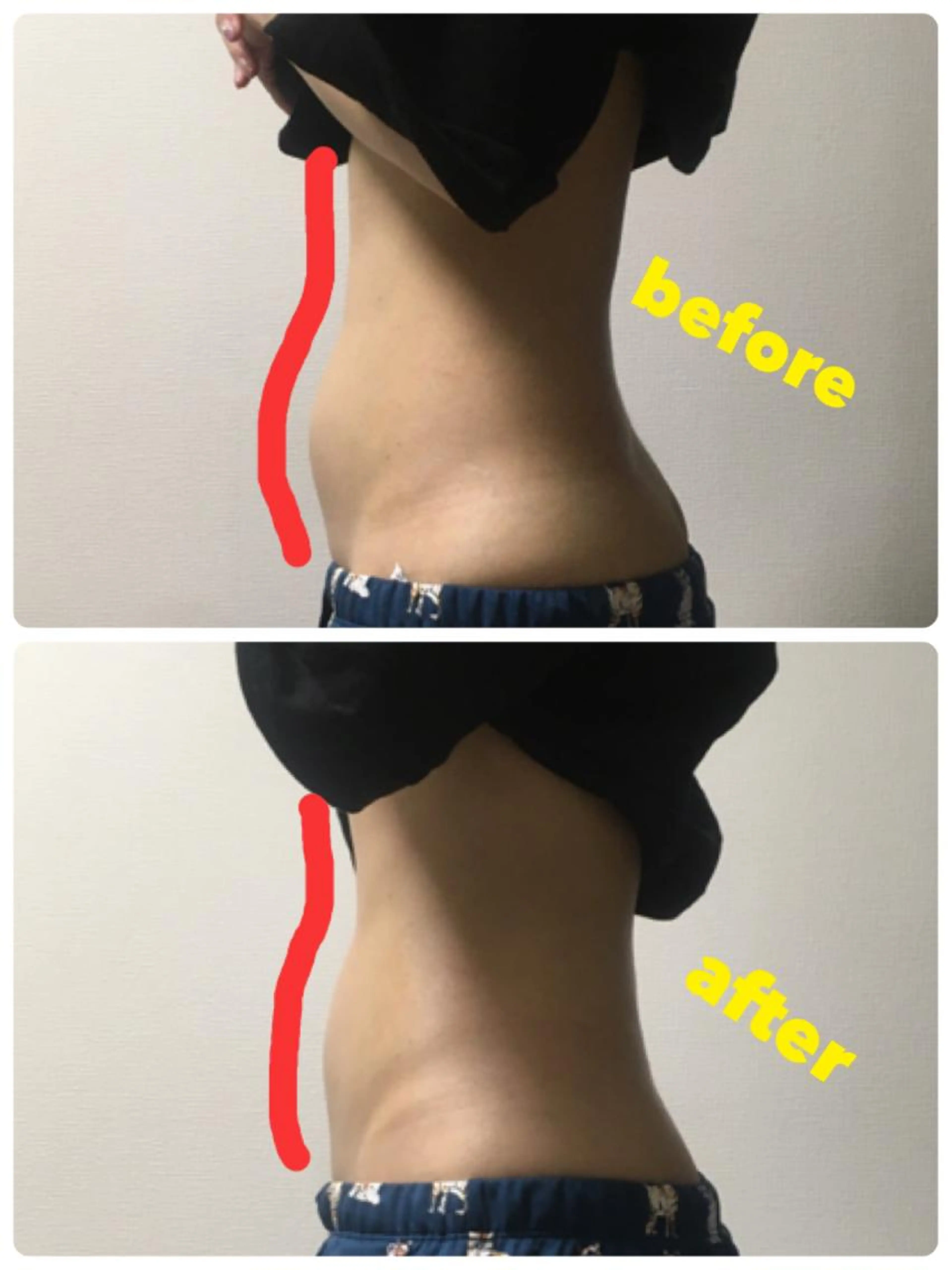 特別キャンペーン💫美容鍼30分＋腸マッサージ30分の計60分💎ポッコリお腹対策🌹内からも外からもキレイに✨の写真