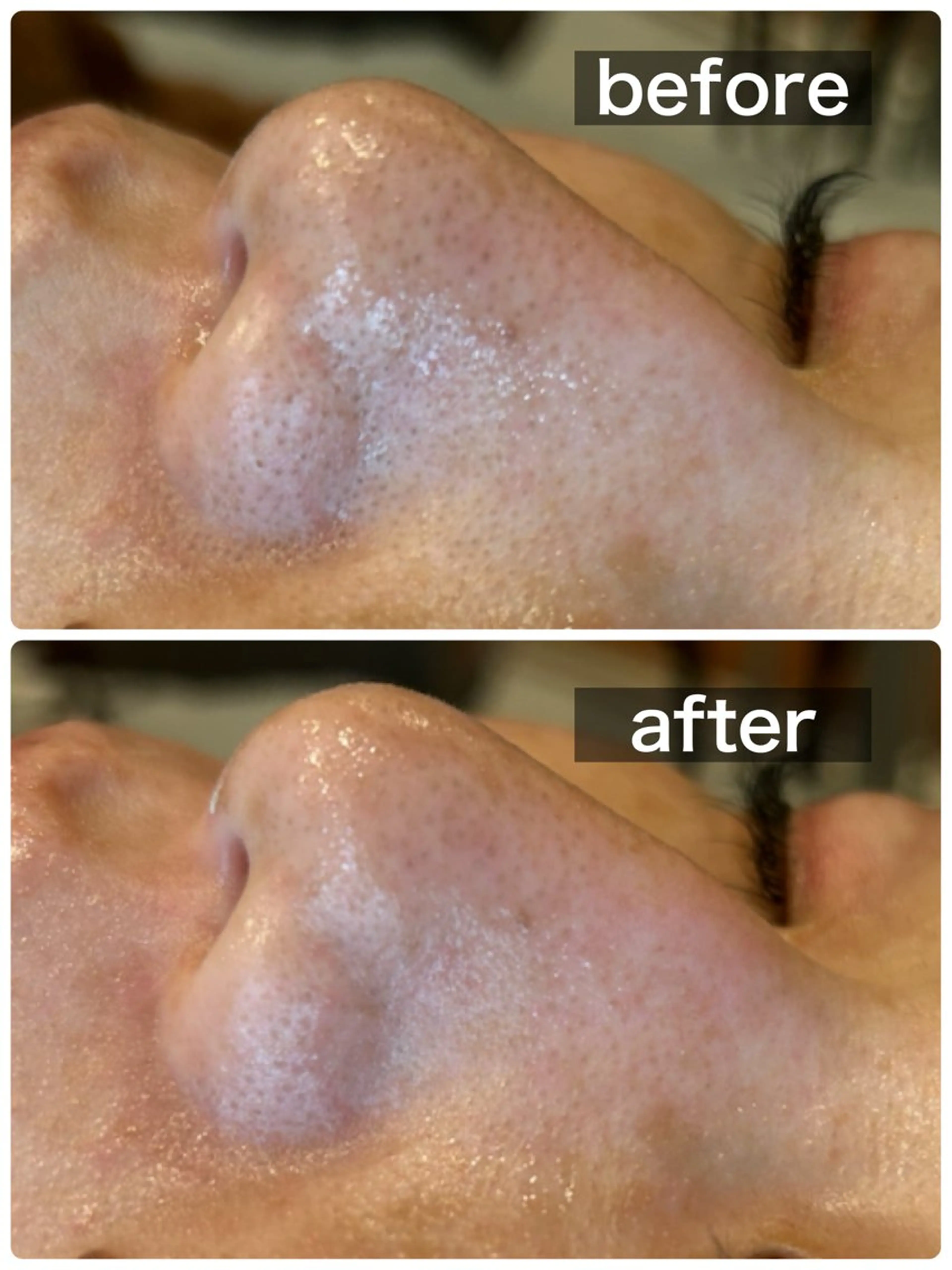 ハイドラ毛穴洗浄コース(50分)の写真