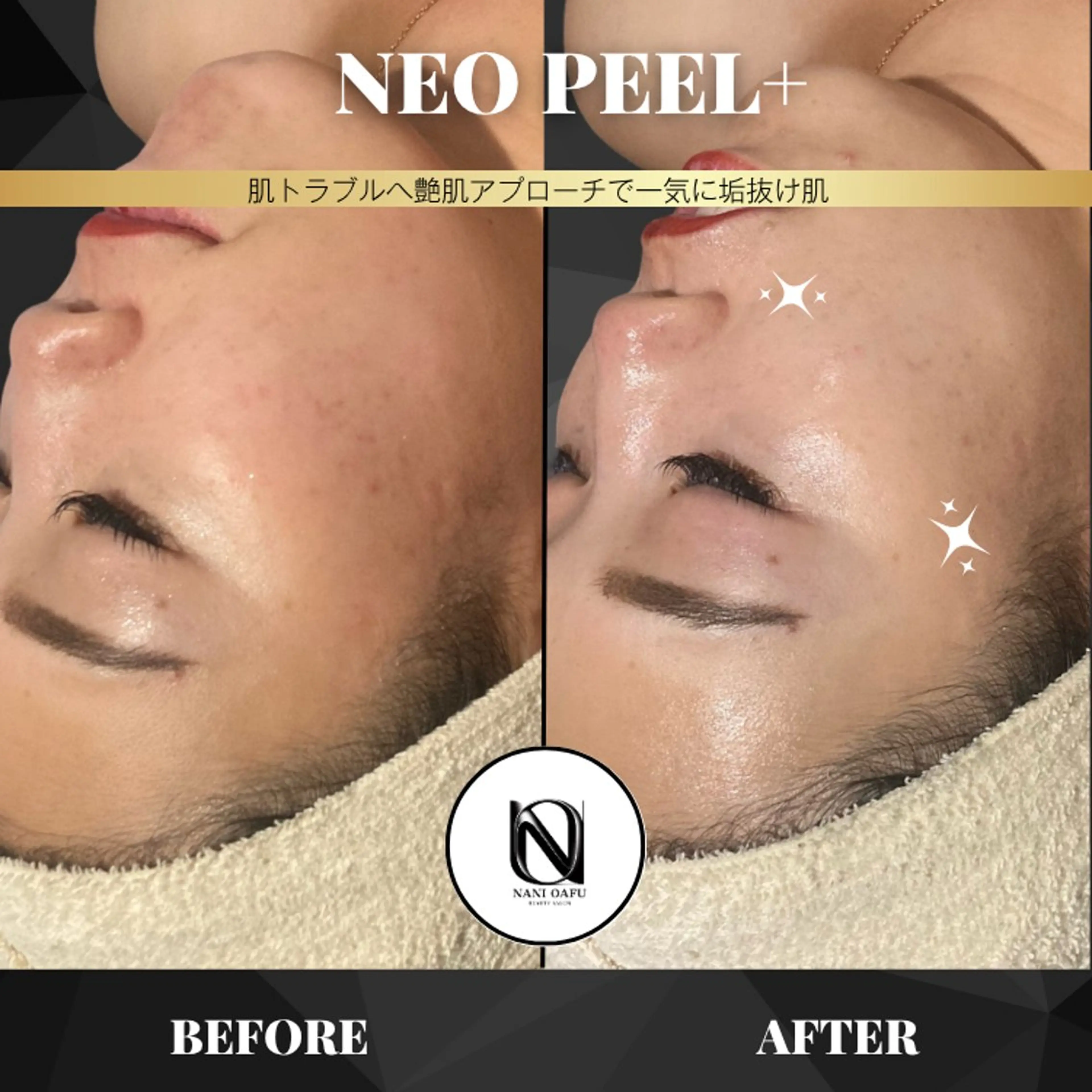 【🫧ニキビ・毛穴・シミ対策】NEOPEEL+|認可取得済みピーリングで肌質改善〈メンズOK〉の写真