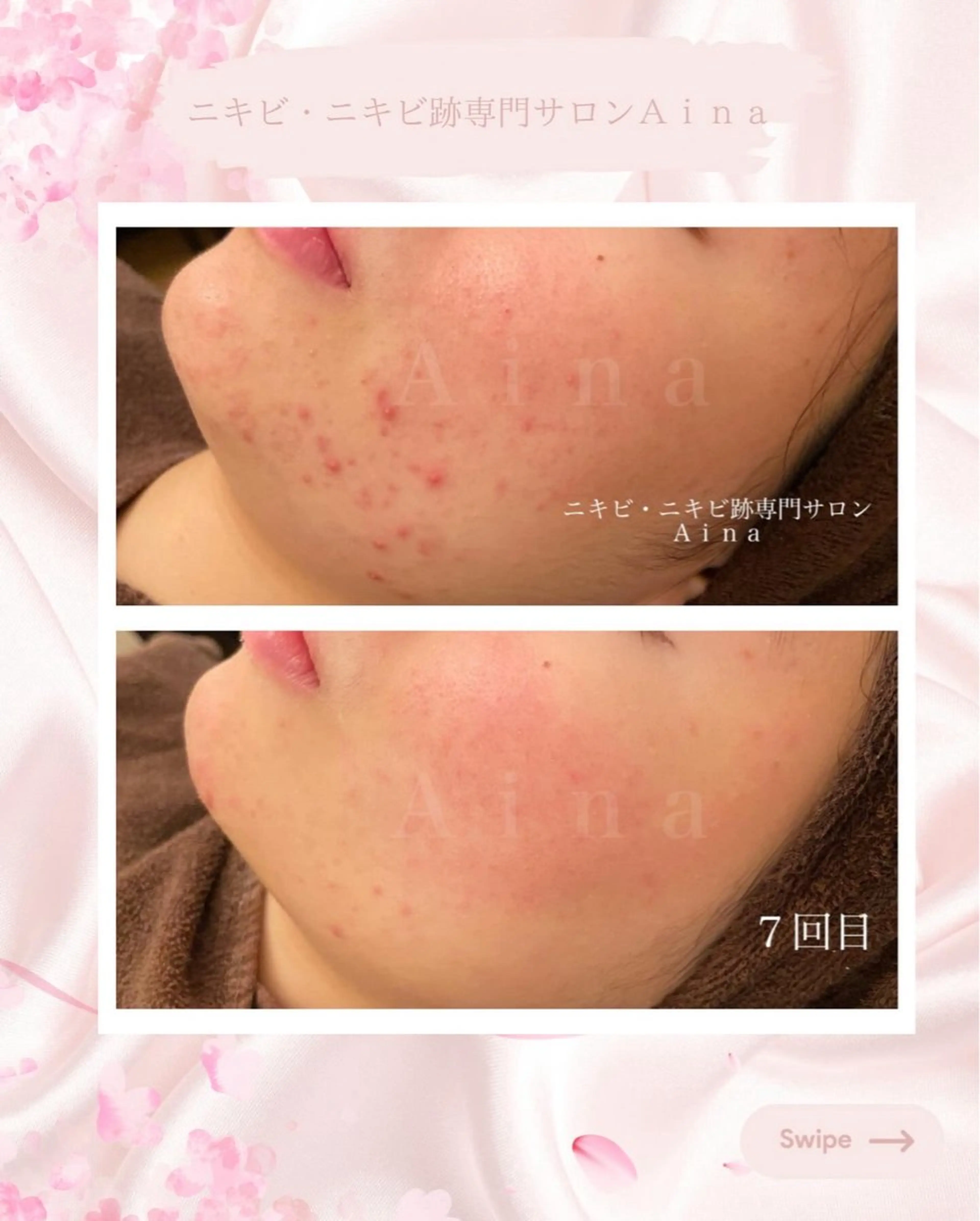 エステ リラク ニキビ跡専門サロン Ａｉｎａのエステ・リラクイメージ