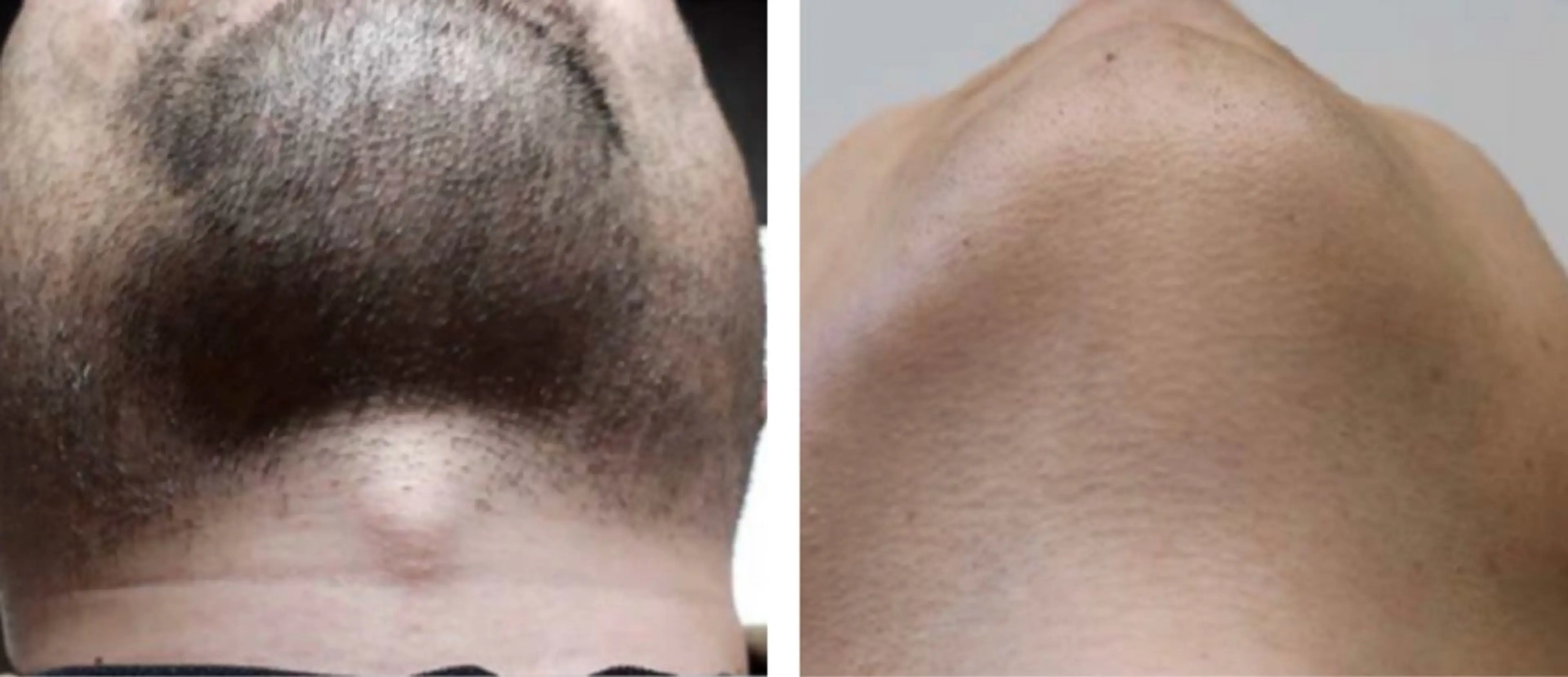 毎朝のシェービング卒業★ヒゲ脱毛2回の写真