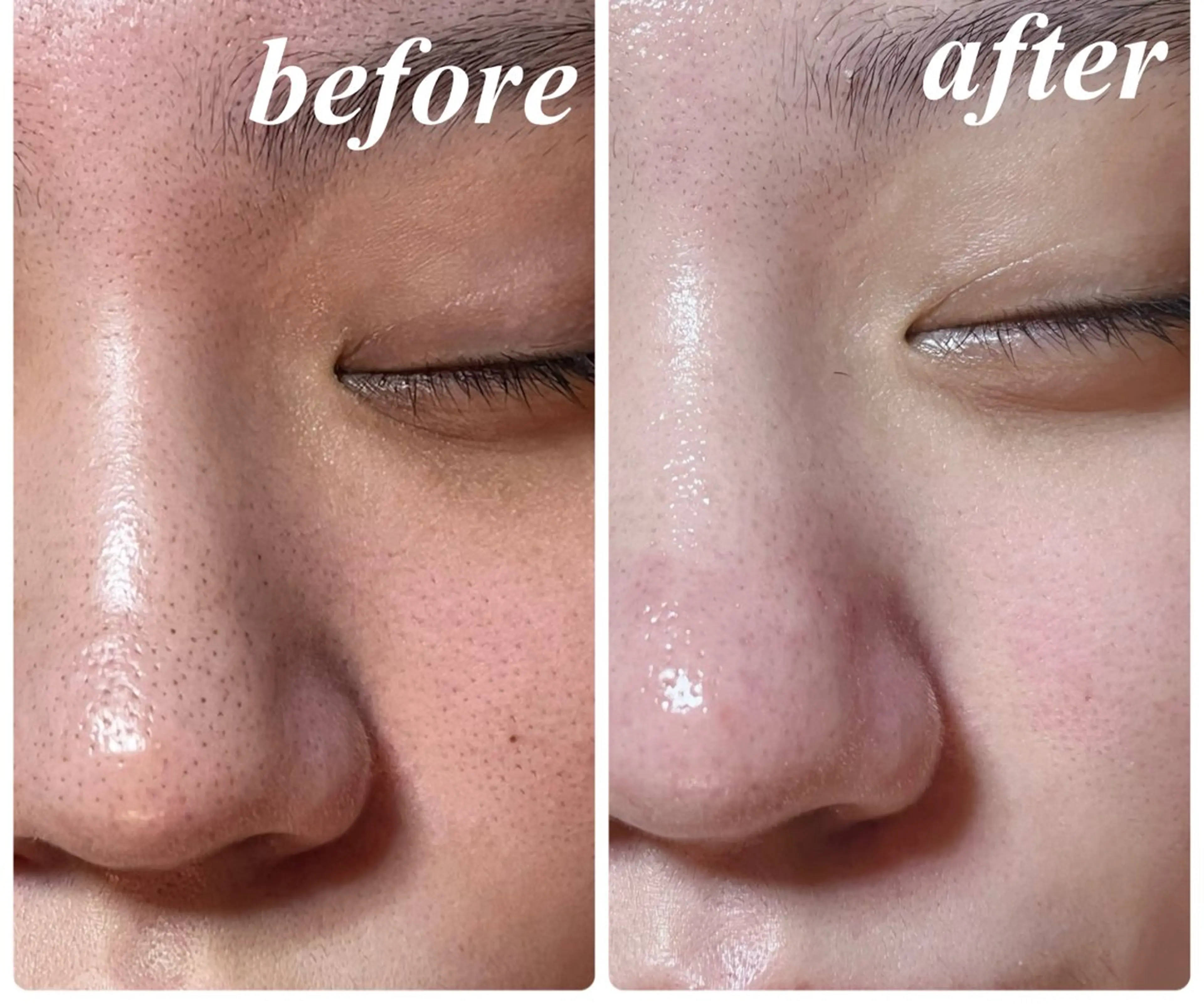 ✨感動のツルツル肌✨【全顔】毛穴エクストラクション90分　(小鼻周り•ホホ•オデコ•顎•眉間/黒ずみ/詰まり/開き)の写真