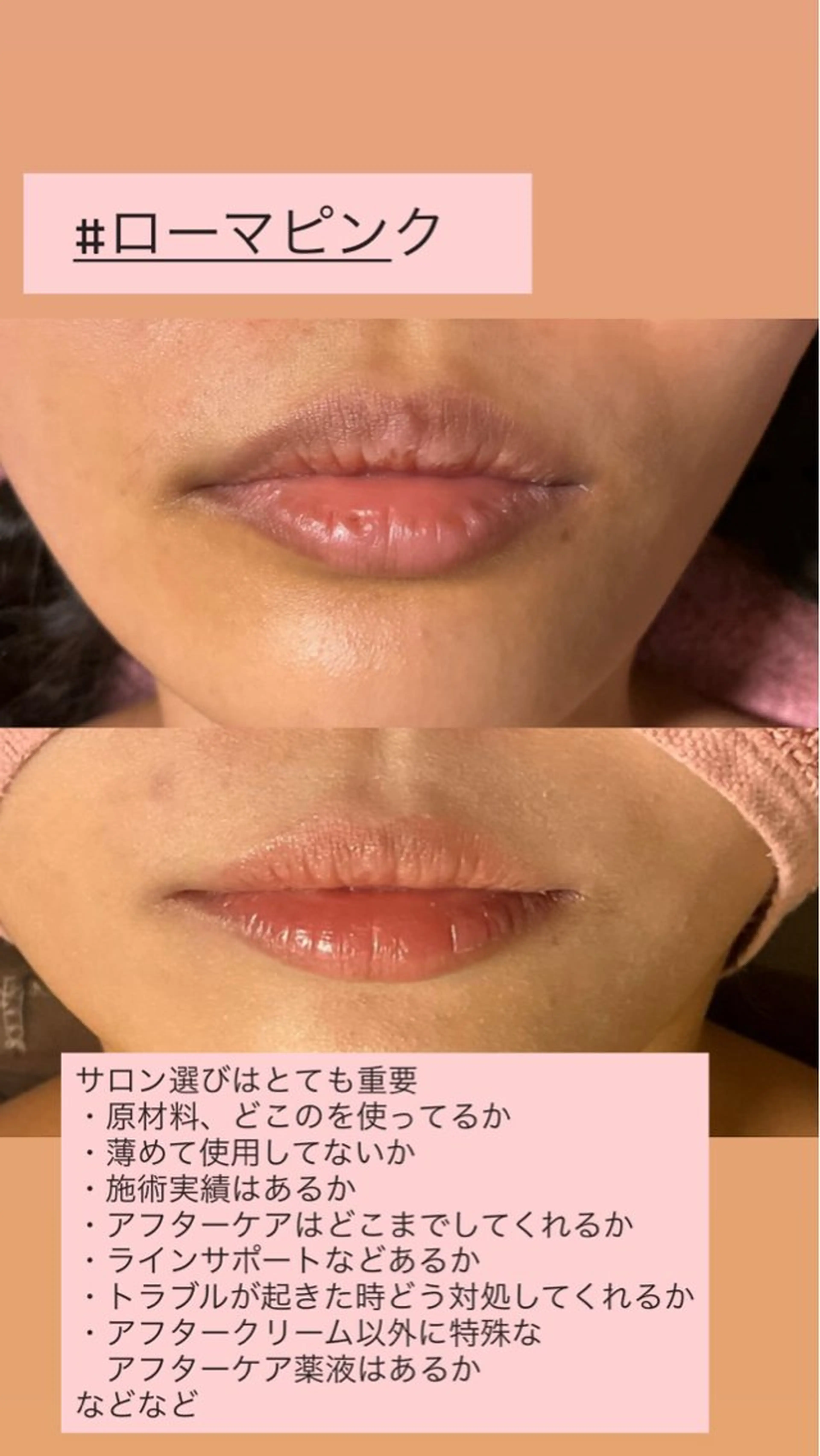🩷ローマピンク🩷　無料カウンセリング予約はこちら！リップ　半額キャンペーﾝ85000円！当日施術可能！の写真