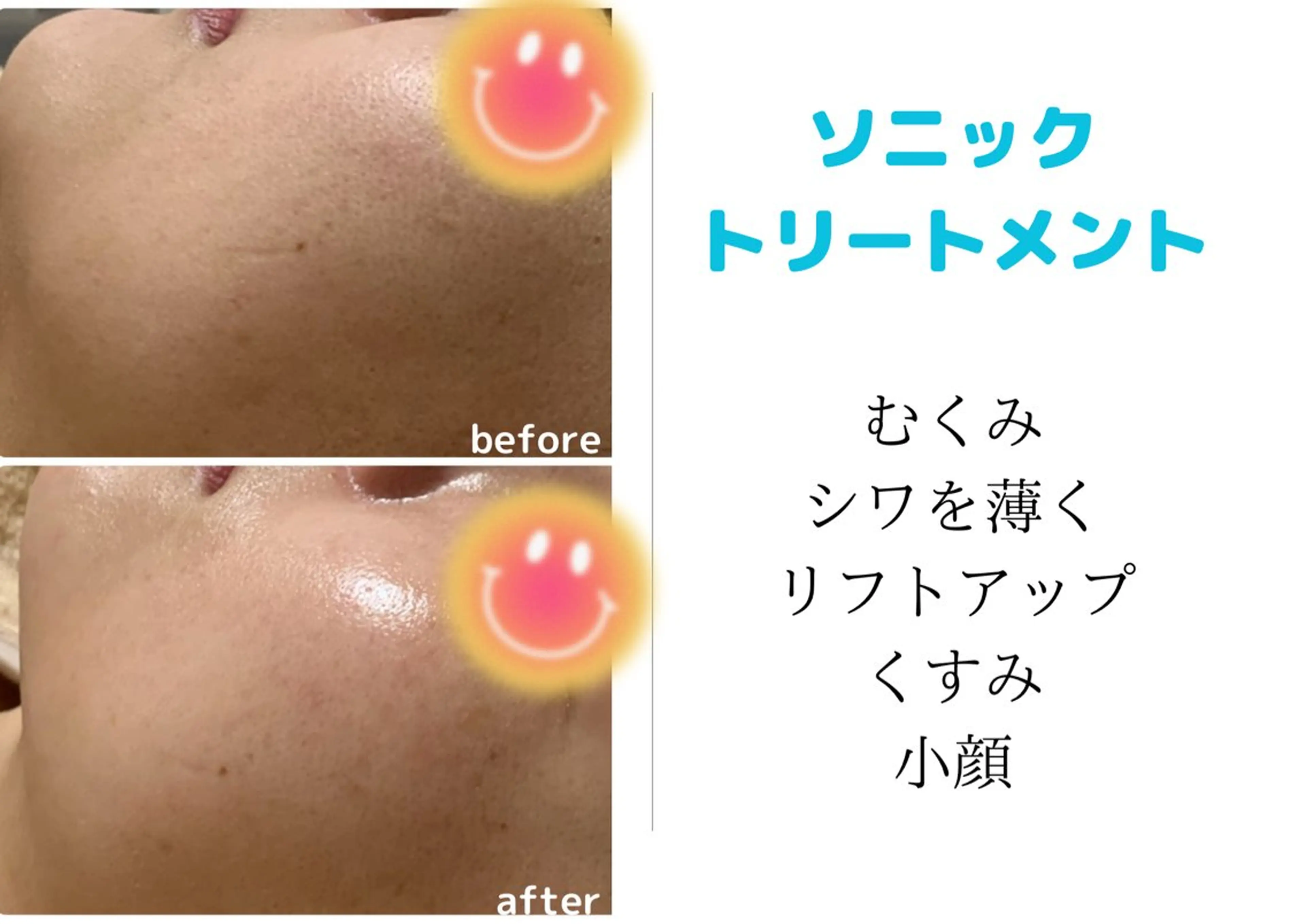 ☀️朝割☀️【10時​〜​13時】お手入れに迷った時はこちらがオススメ💁‍♀️ソニックトリートメントエステ💆‍♀️の写真