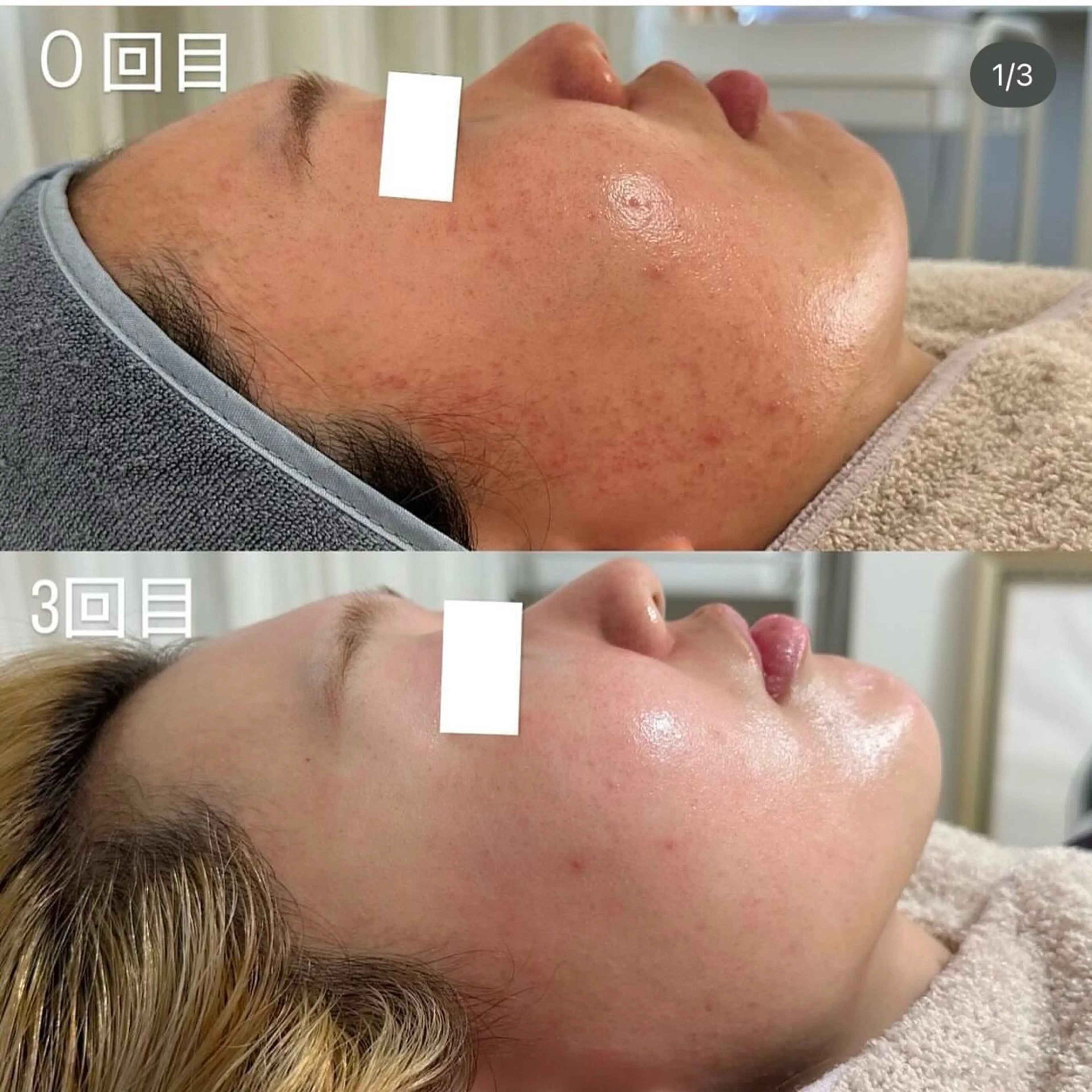 【国内最高濃度ピーリング】韓国美肌/肌質シミ改善/ニキビケア16800→14800の写真