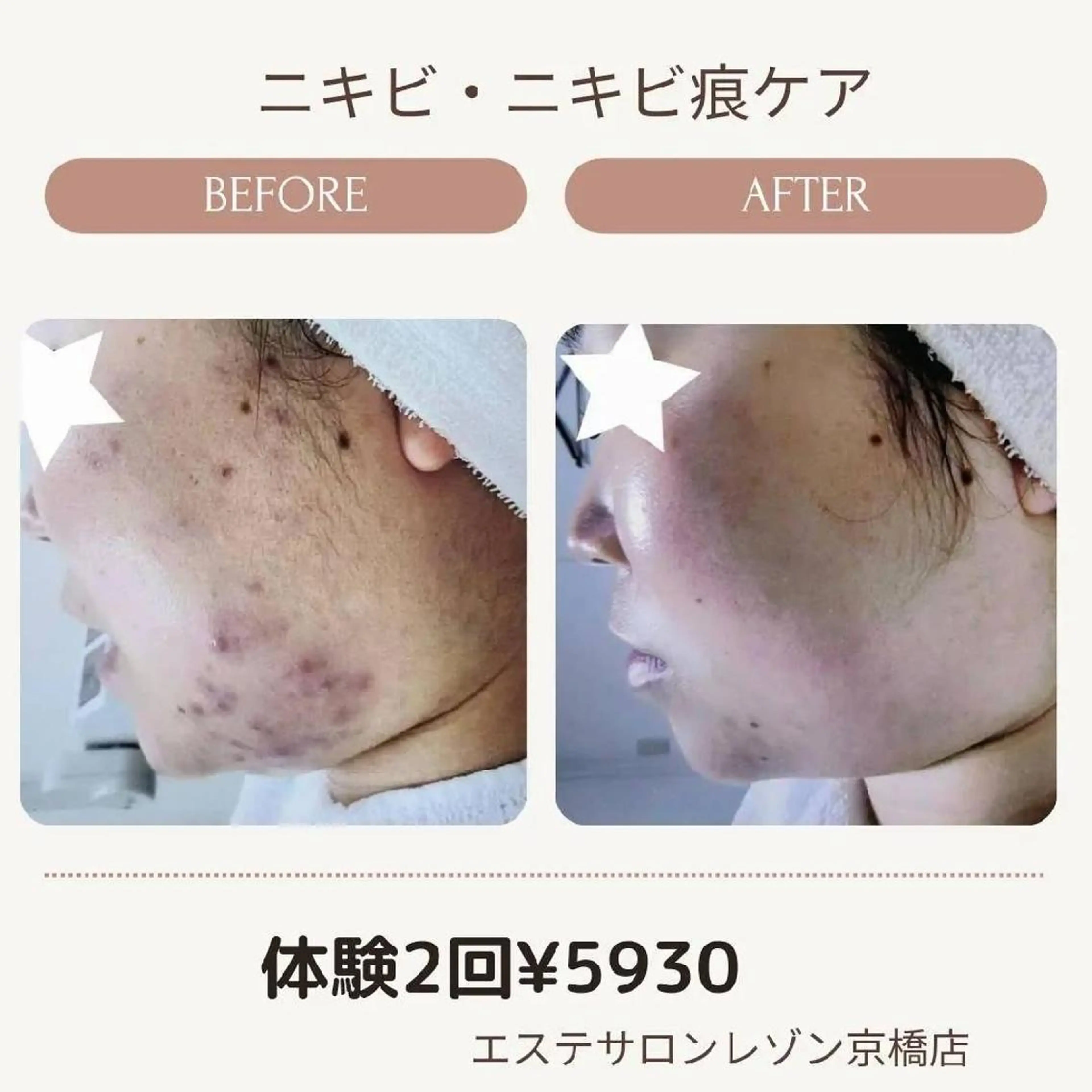 エステ ニキビケア◇ニキビ跡 レゾン京橋店　峠山のエステ・リラクイメージ