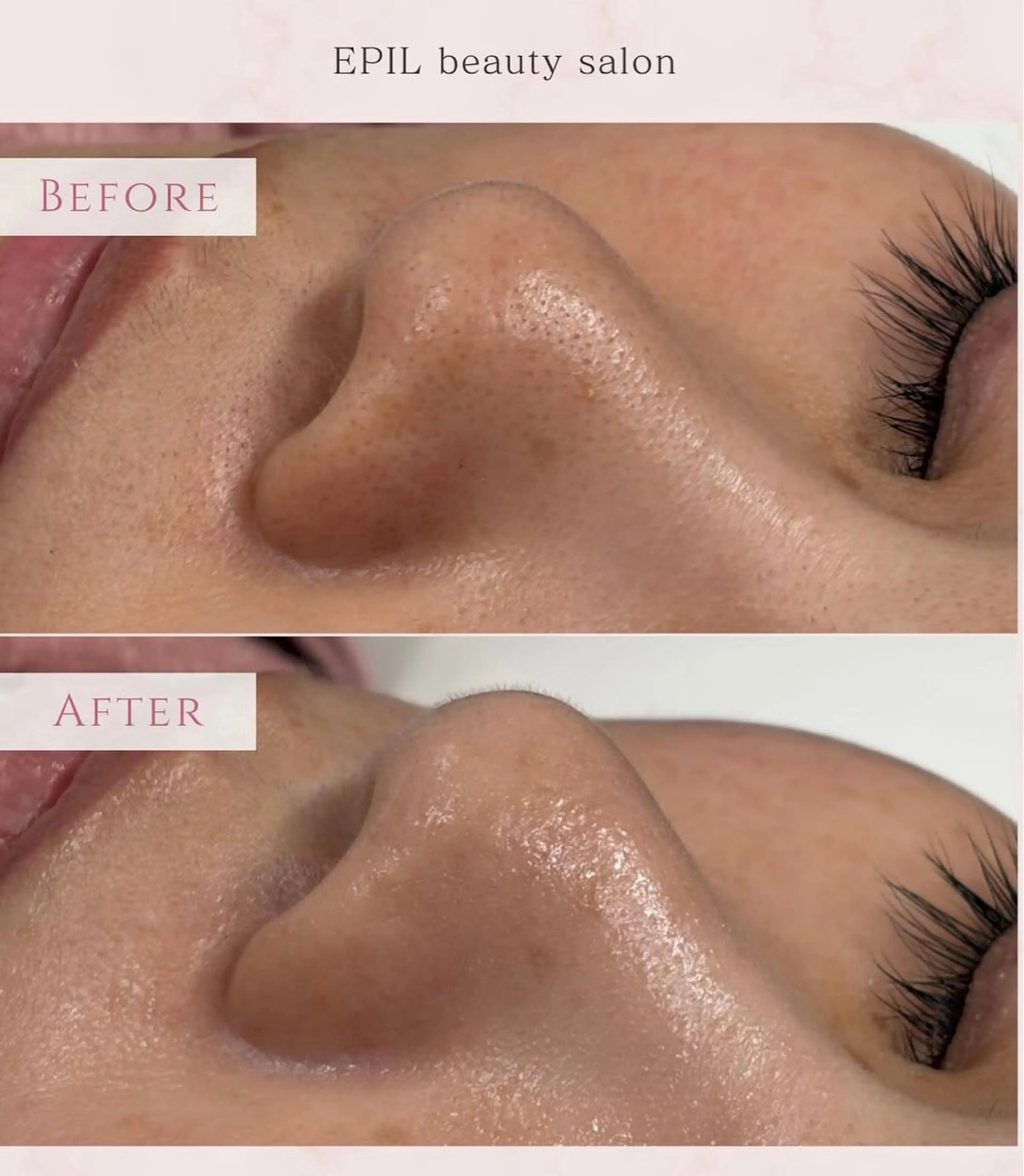 エステ EPIL Beauty Salon所属・akane .のエステ・リラクイメージ