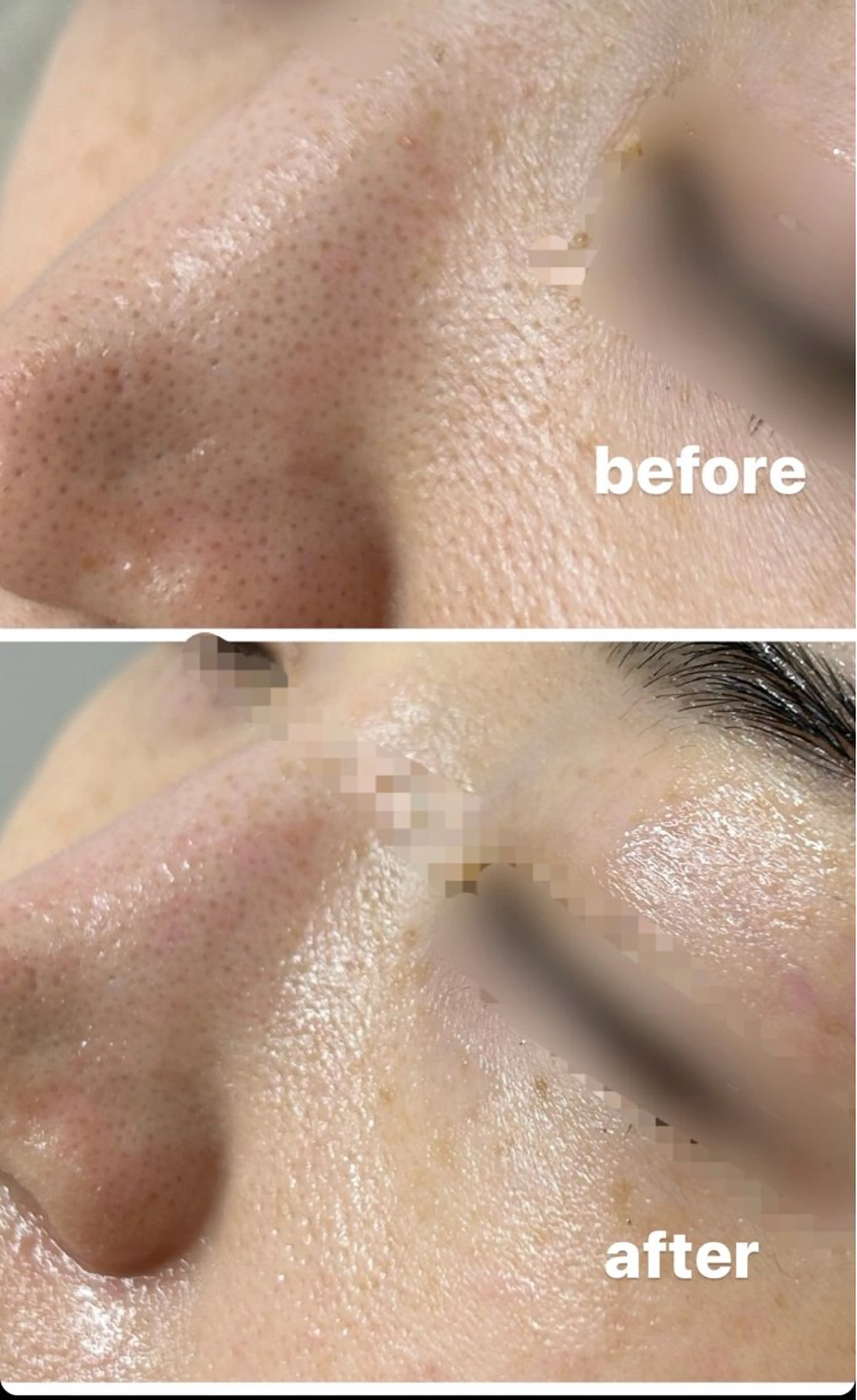 新発想・美容液で洗う毛穴洗浄】ハイドロピーリング✖️ヒト幹細胞パック　毛穴/くすみ/ニキビ/ニキビ跡の写真