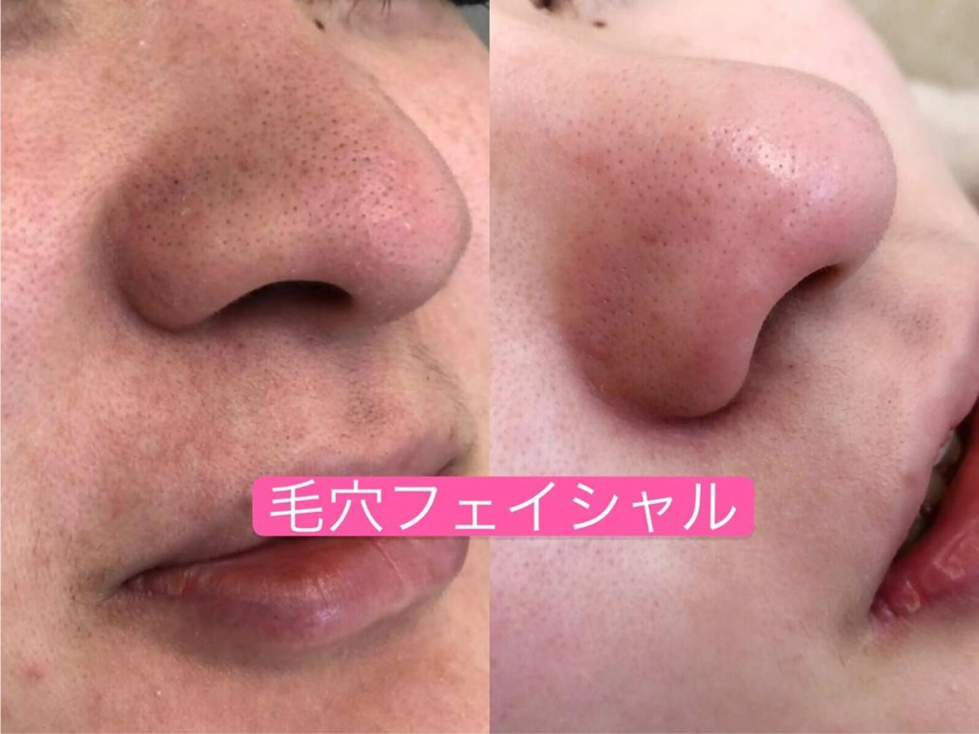 エステ リラク 毛穴洗浄& 睫毛パーマ上野御徒町のマツエク・マツパデザイン