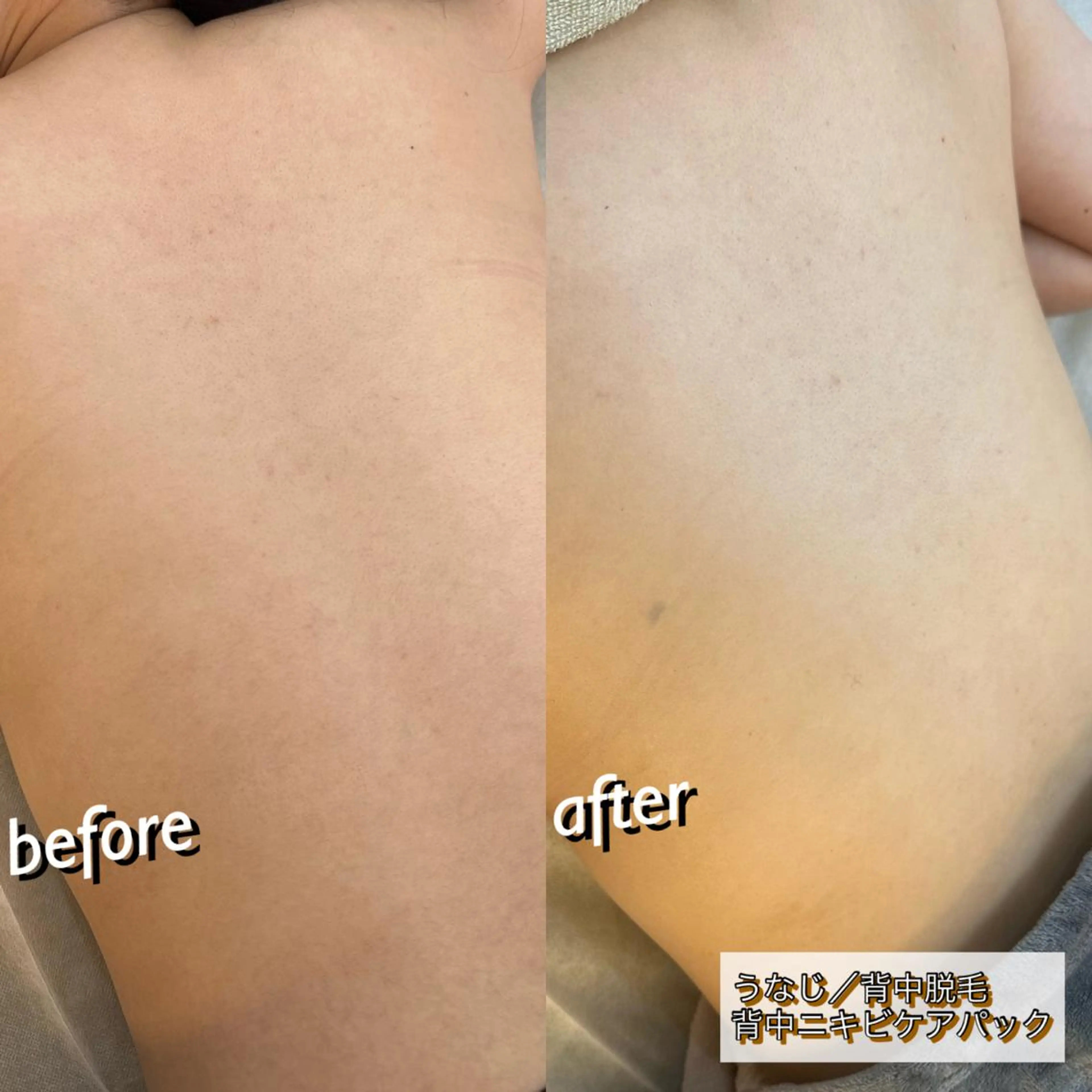 うなじ脱毛/美肌脱毛 LABELのエステ・リラクイメージ