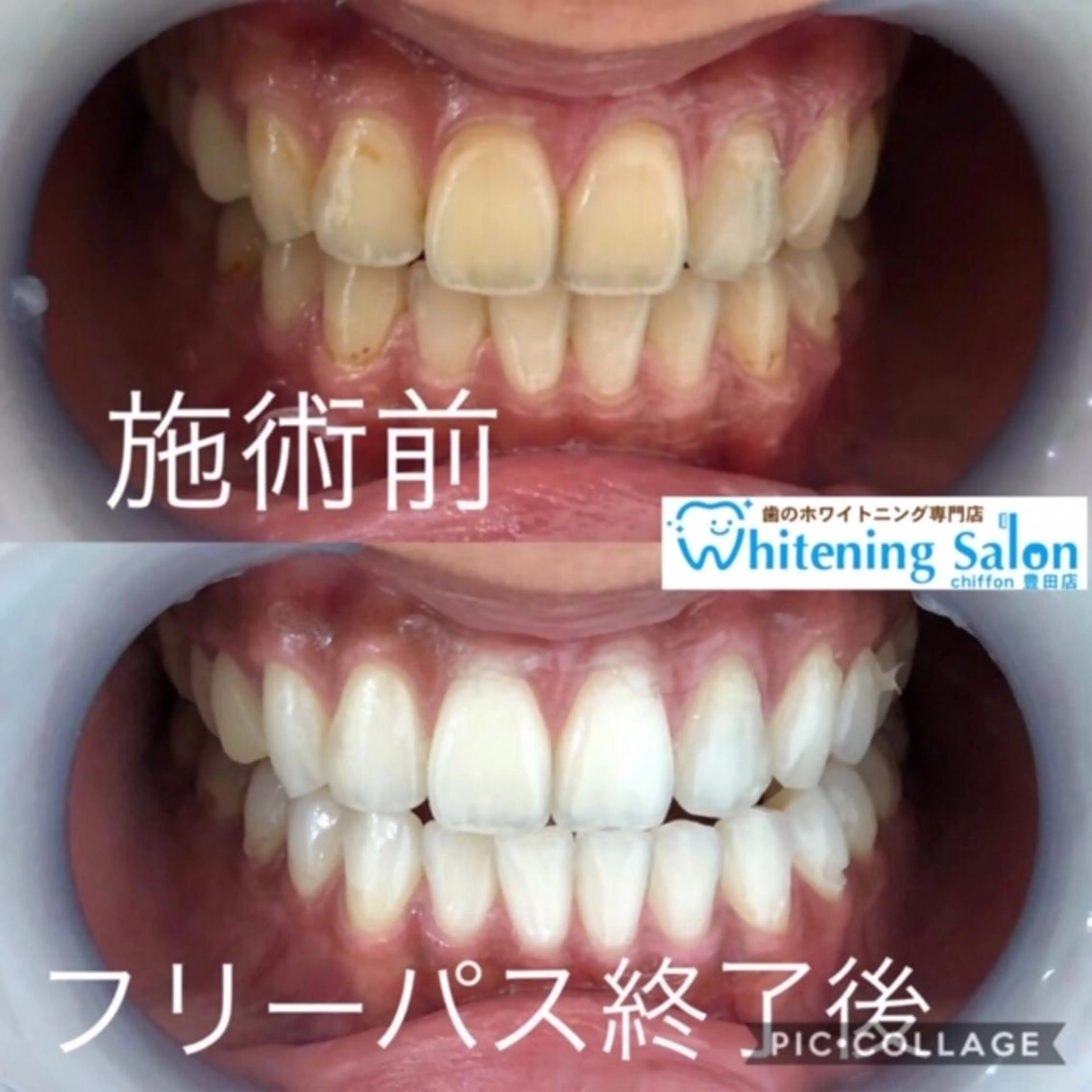 【ミニモ学割】せっかくホワイトニングするなら確実に白くしたい！24回数券★有効期限なし！！の写真