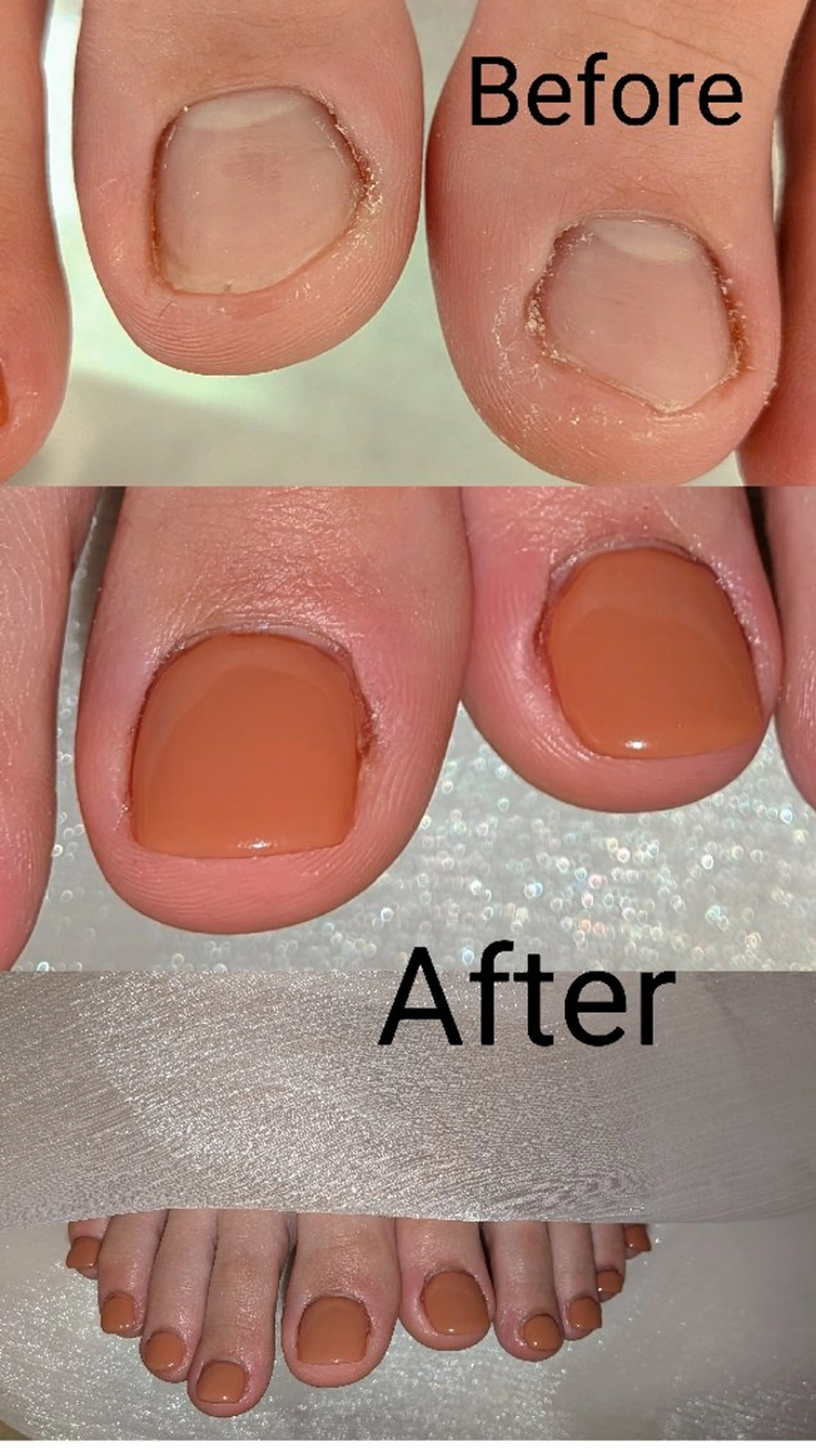 ネイル フットネイル フットネイル ネイリストゆか💅 長さだし、深爪矯正のネイルデザイン