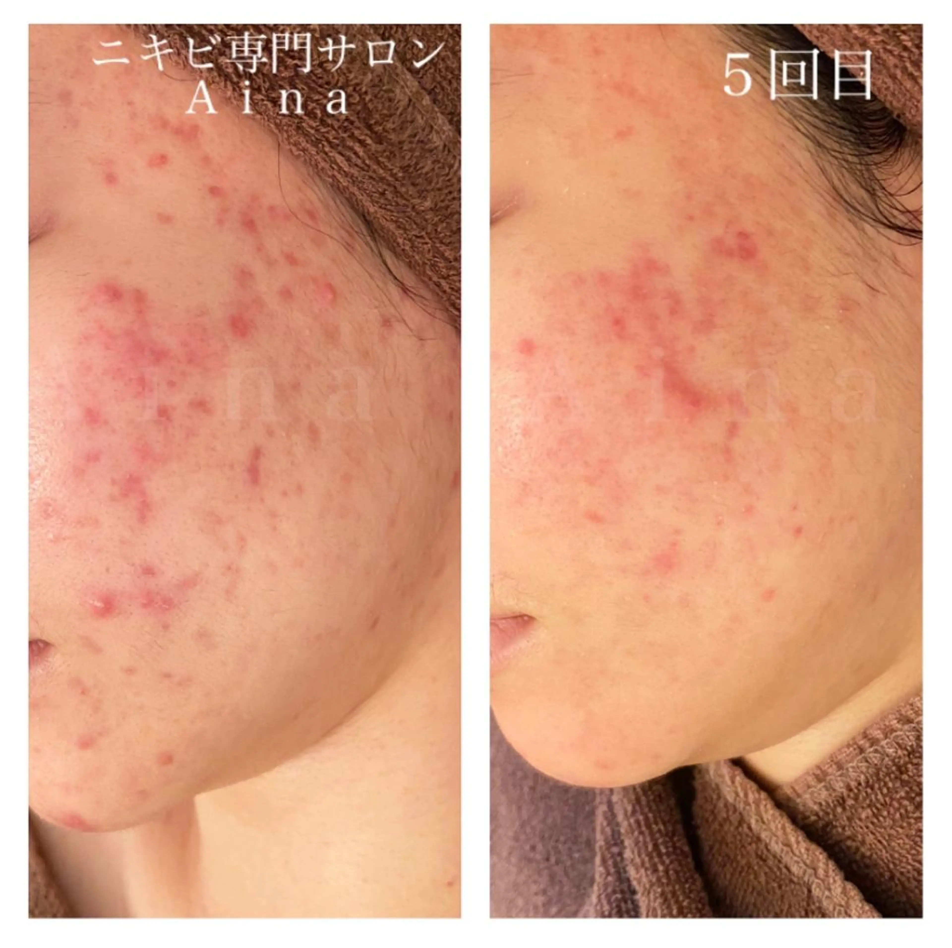 ミディアム カラー パーマ ヘアアレンジ メンズ キッズ ネイル マツエク・マツパ 学生（メンズ向け） 学生 エステ リラク ニキビ跡専門サロン Ａｉｎａのエステ・リラクイメージ