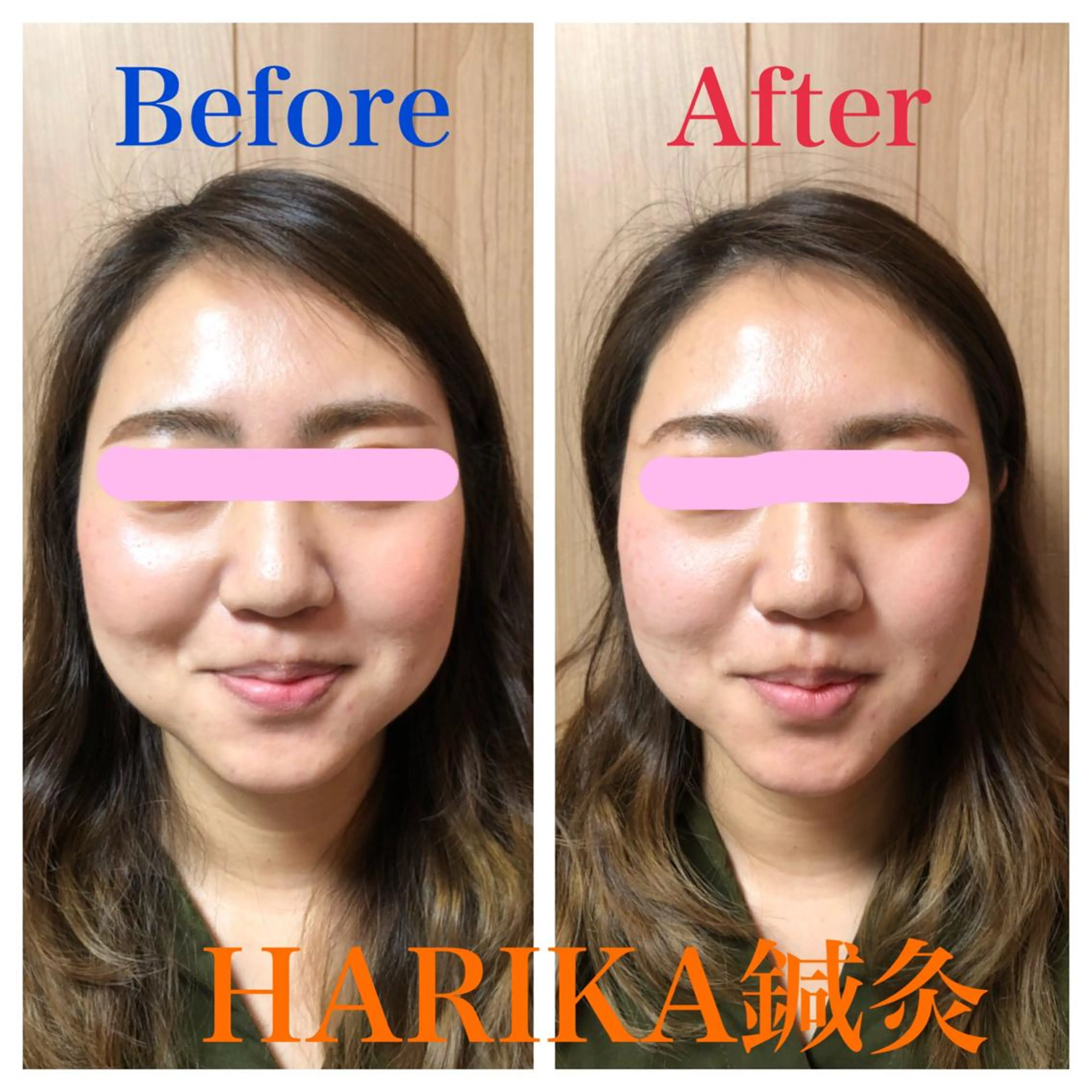 HARIKA鍼灸所属・HARIKA 鍼灸のその他イメージ
