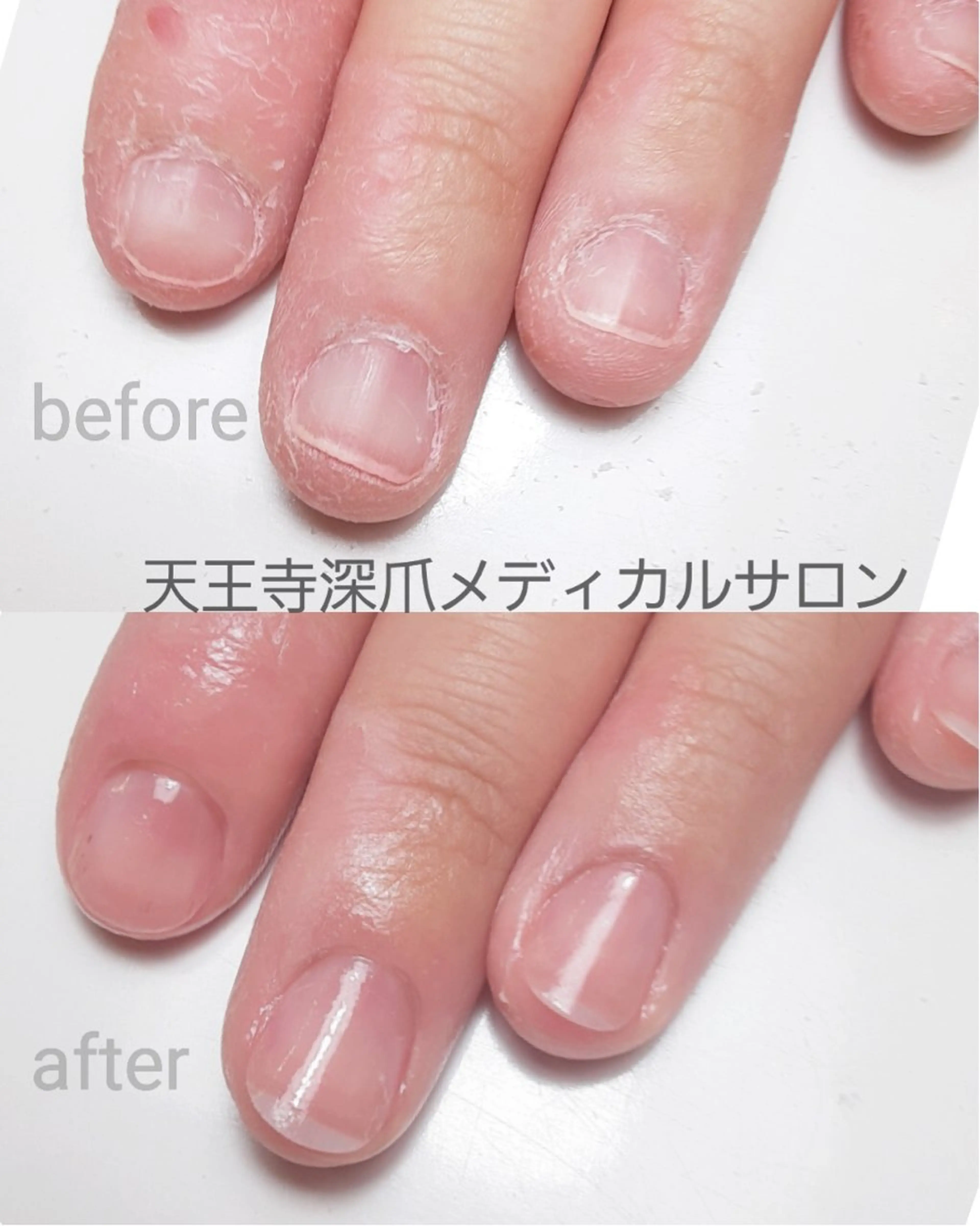 ネイル 天王寺 深爪メディカルサロンのネイルデザイン