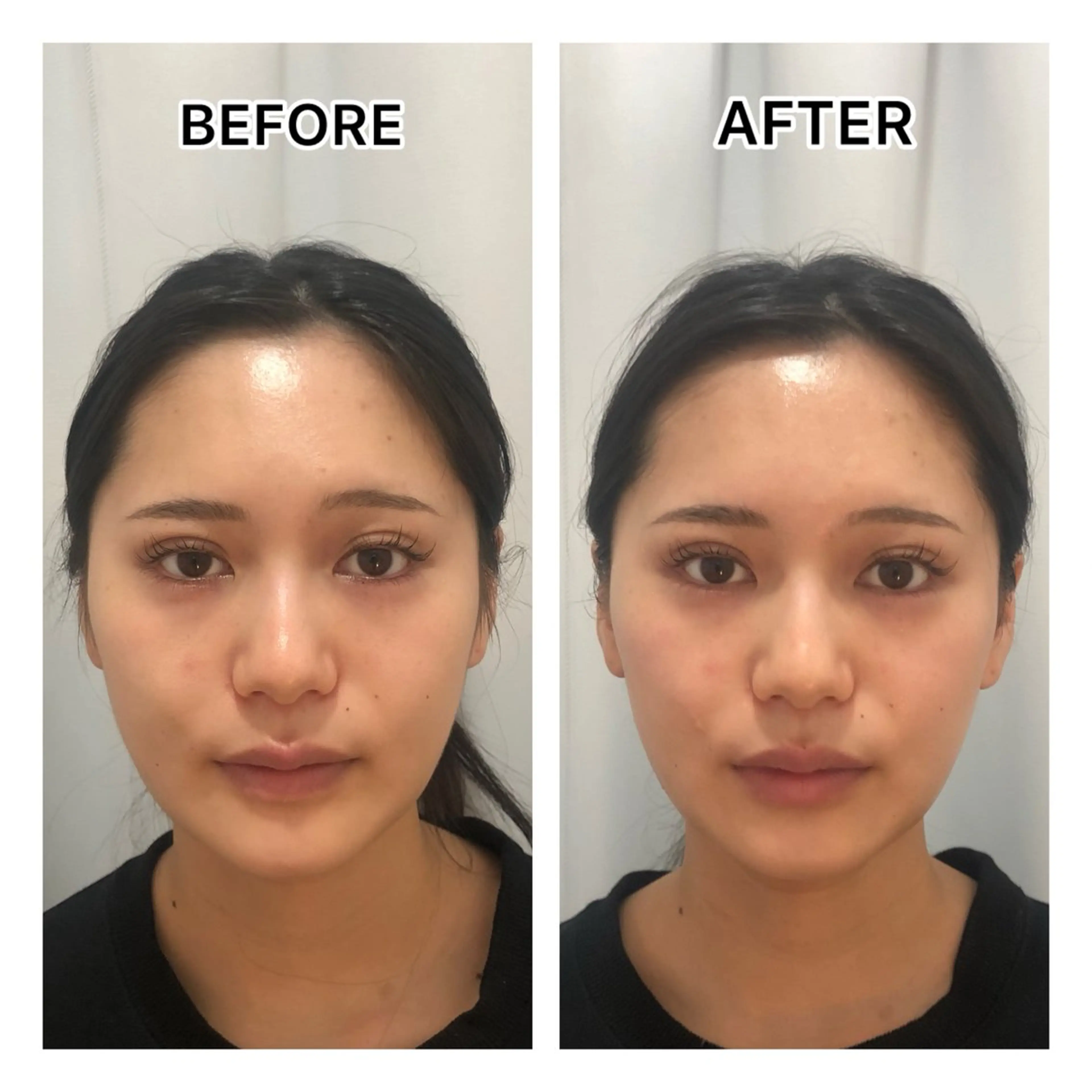 ☆リフトUP特化コース☆小顔ラジオ波+EMS+高保湿パウダーの写真