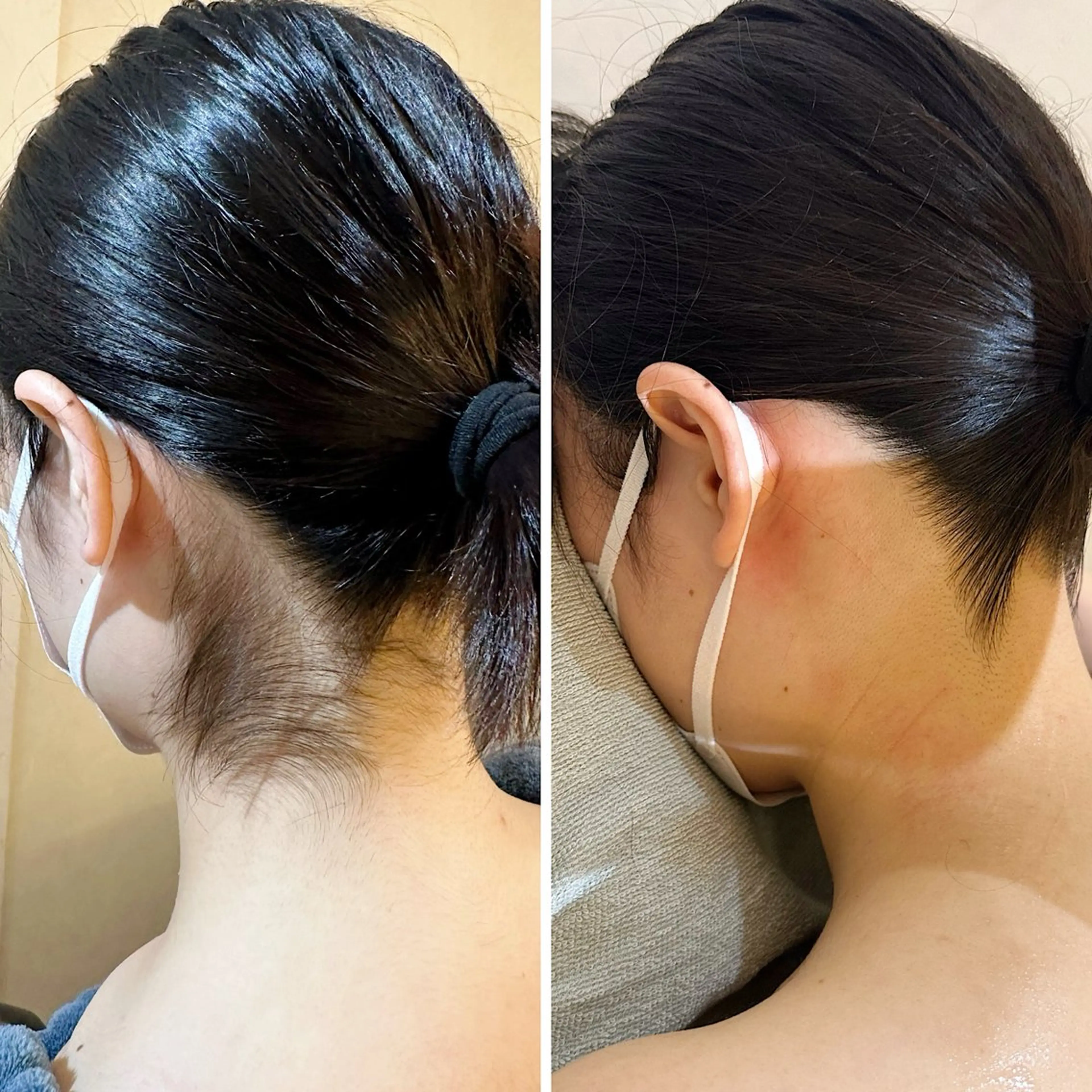 脱毛 うなじ脱毛/美肌脱毛 LABELのエステ・リラクイメージ