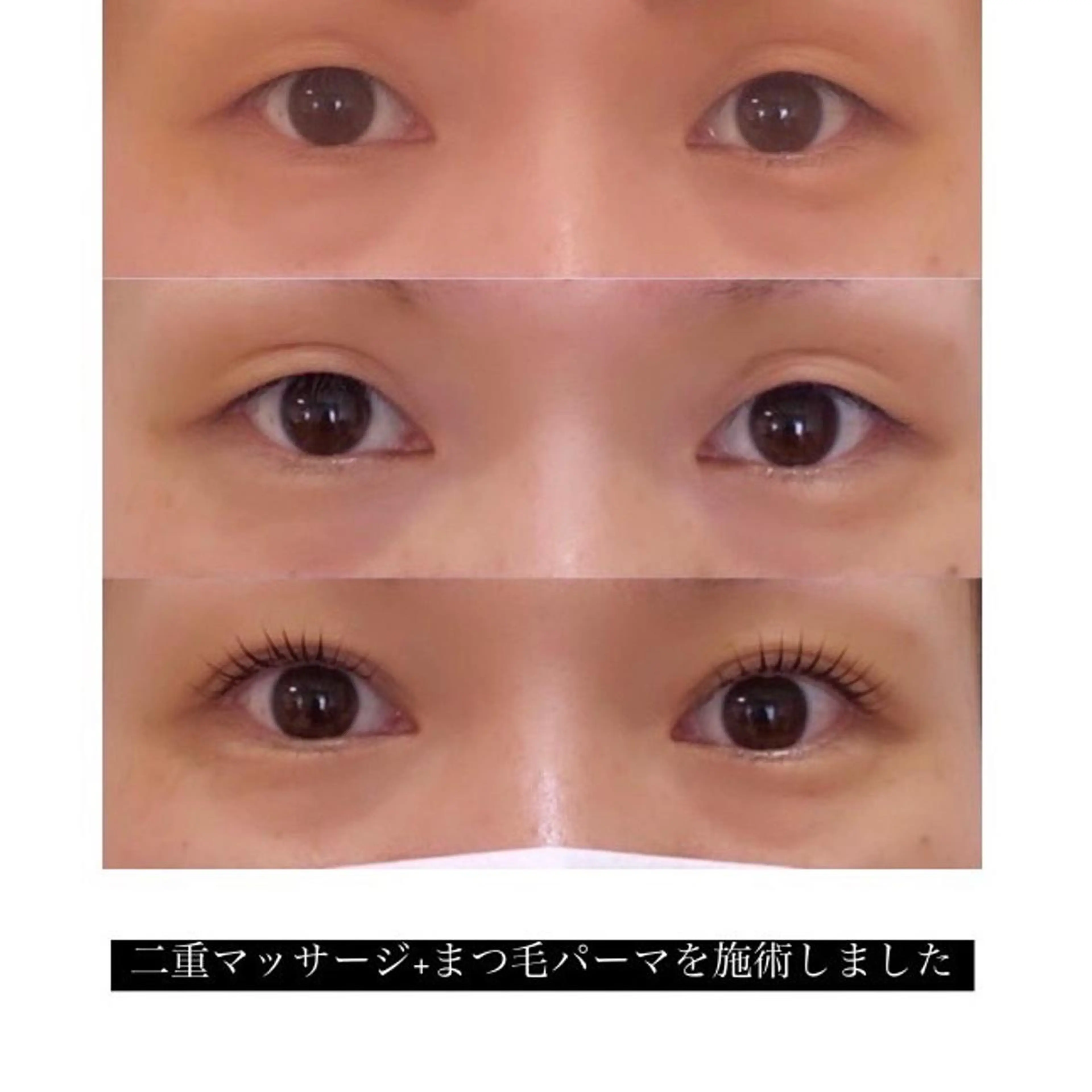 切らずに二重✨ダブルアイリフトの写真