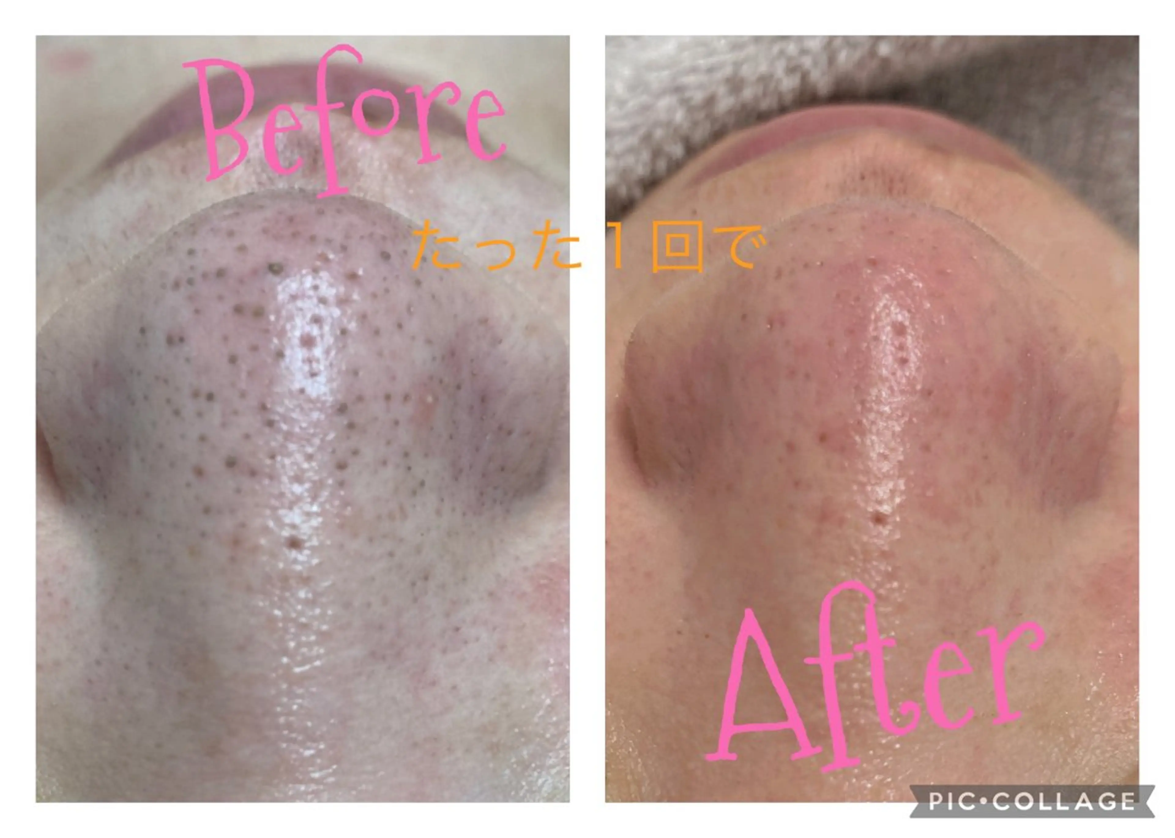 劇的アフター♪結果重視毛穴洗浄！！の写真
