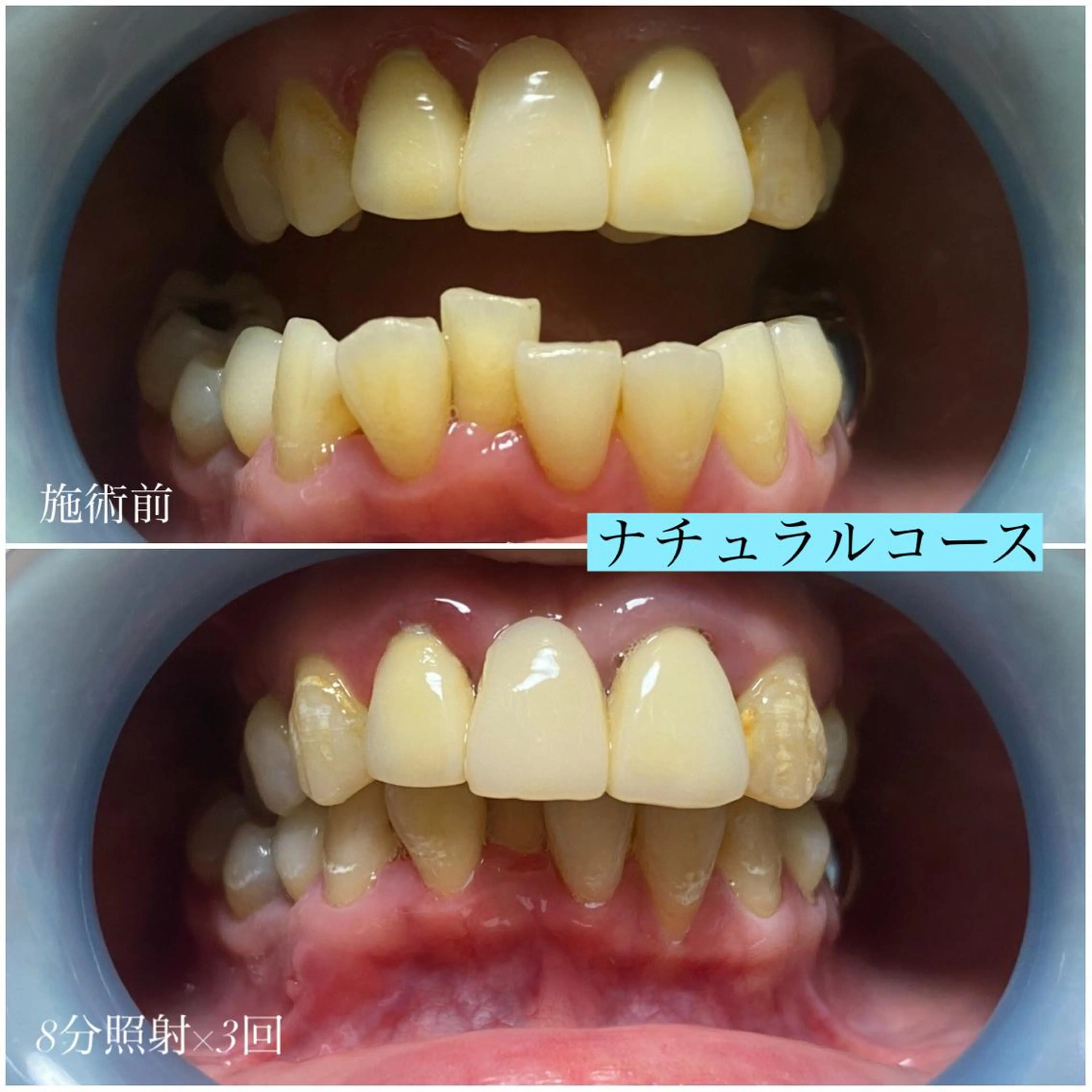 ネイル/耳つぼ /新ホワイトニングのネイルデザイン