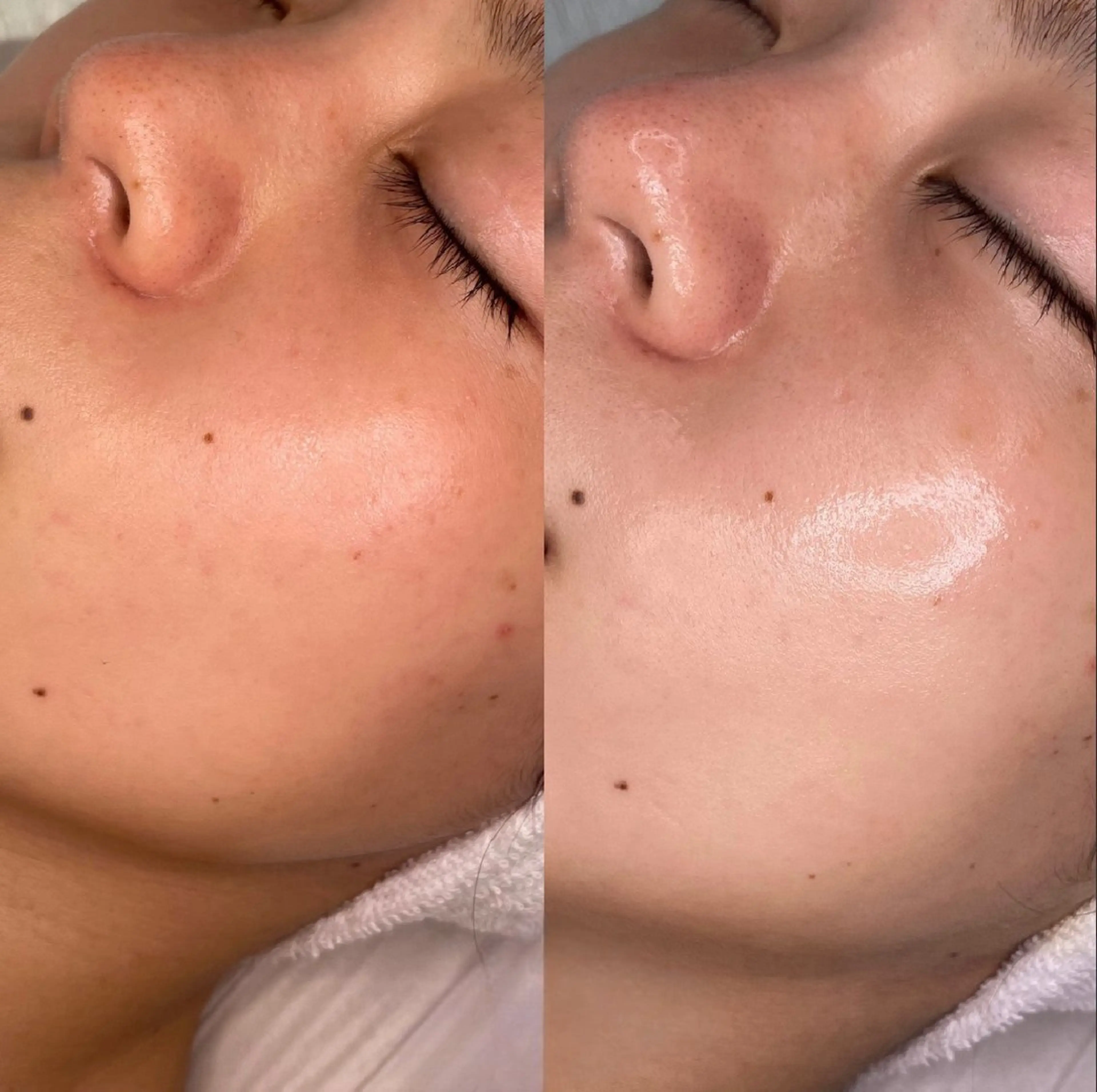 【肌悩み相談OK】どのメニューが合うか迷ったらこちら◎最適メニューをご提案！4980円～の写真