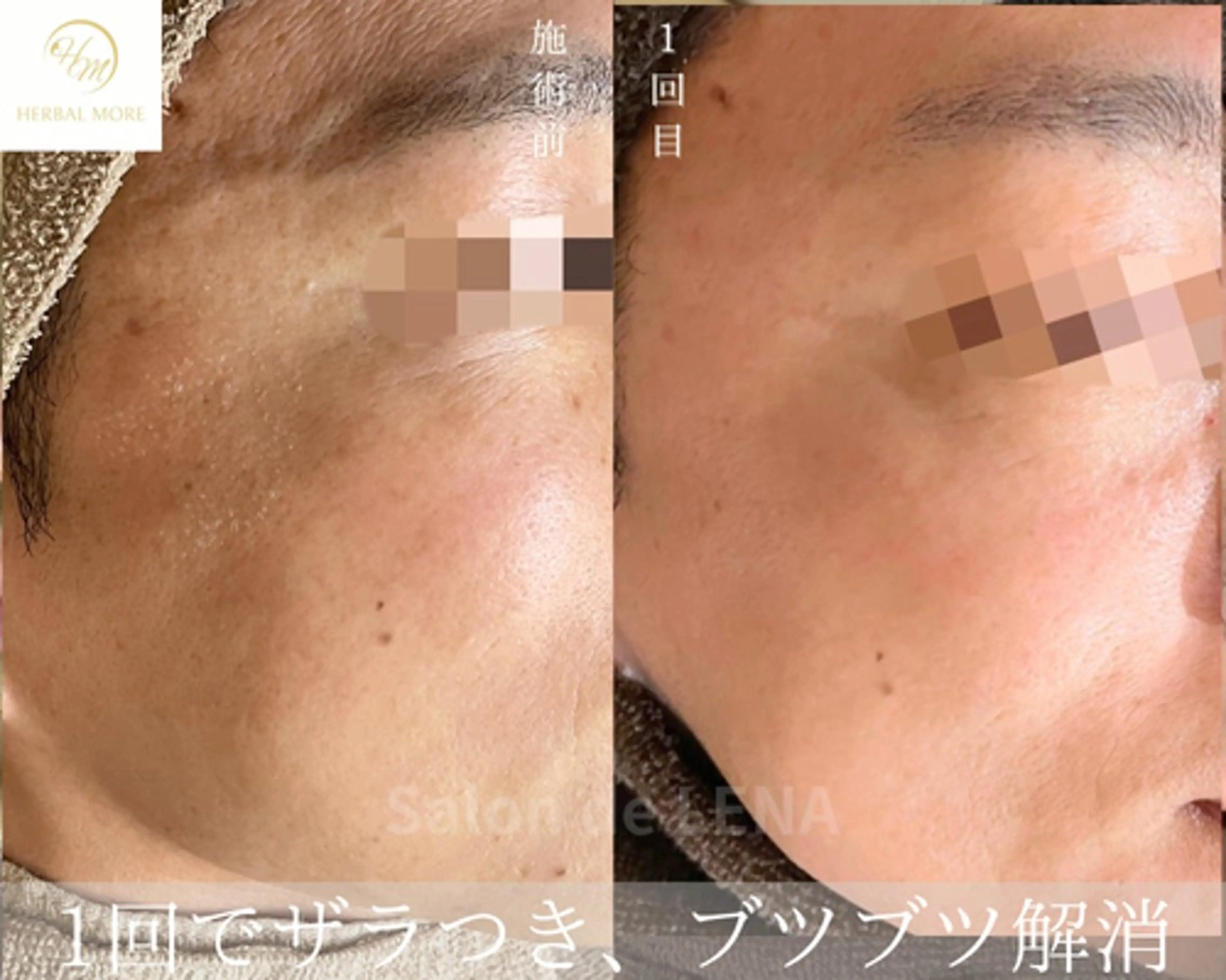 ハーブピーリング・毛穴ケア専門サロンSalon de LENA 栄店所属・ハーブピーリング専門 サロンドレナ　白藤のエステ・リラクイメージ