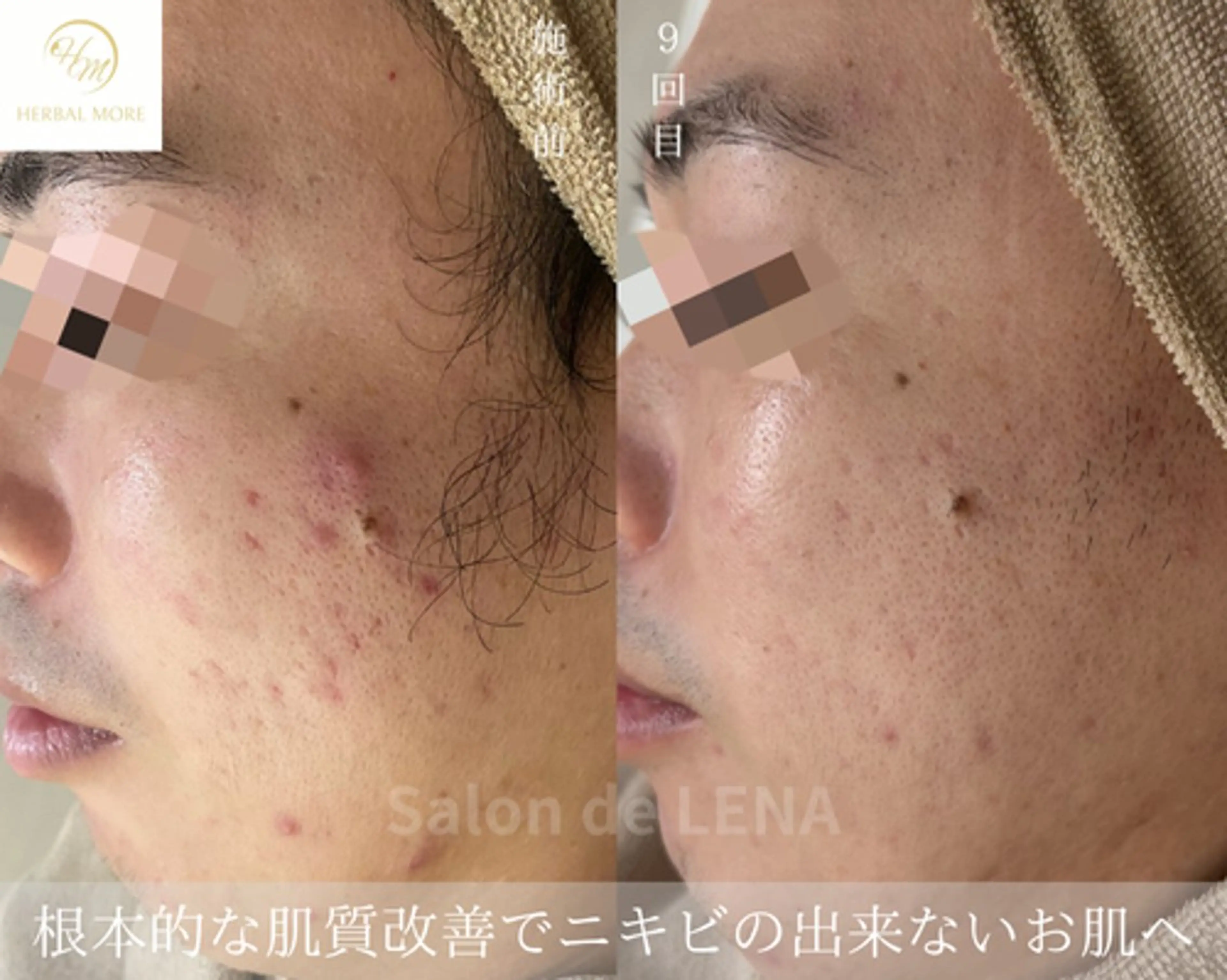 ハーブピーリング・毛穴ケア専門サロンSalon de LENA 栄店所属・ハーブピーリング専門 サロンドレナ　白藤のエステ・リラクイメージ