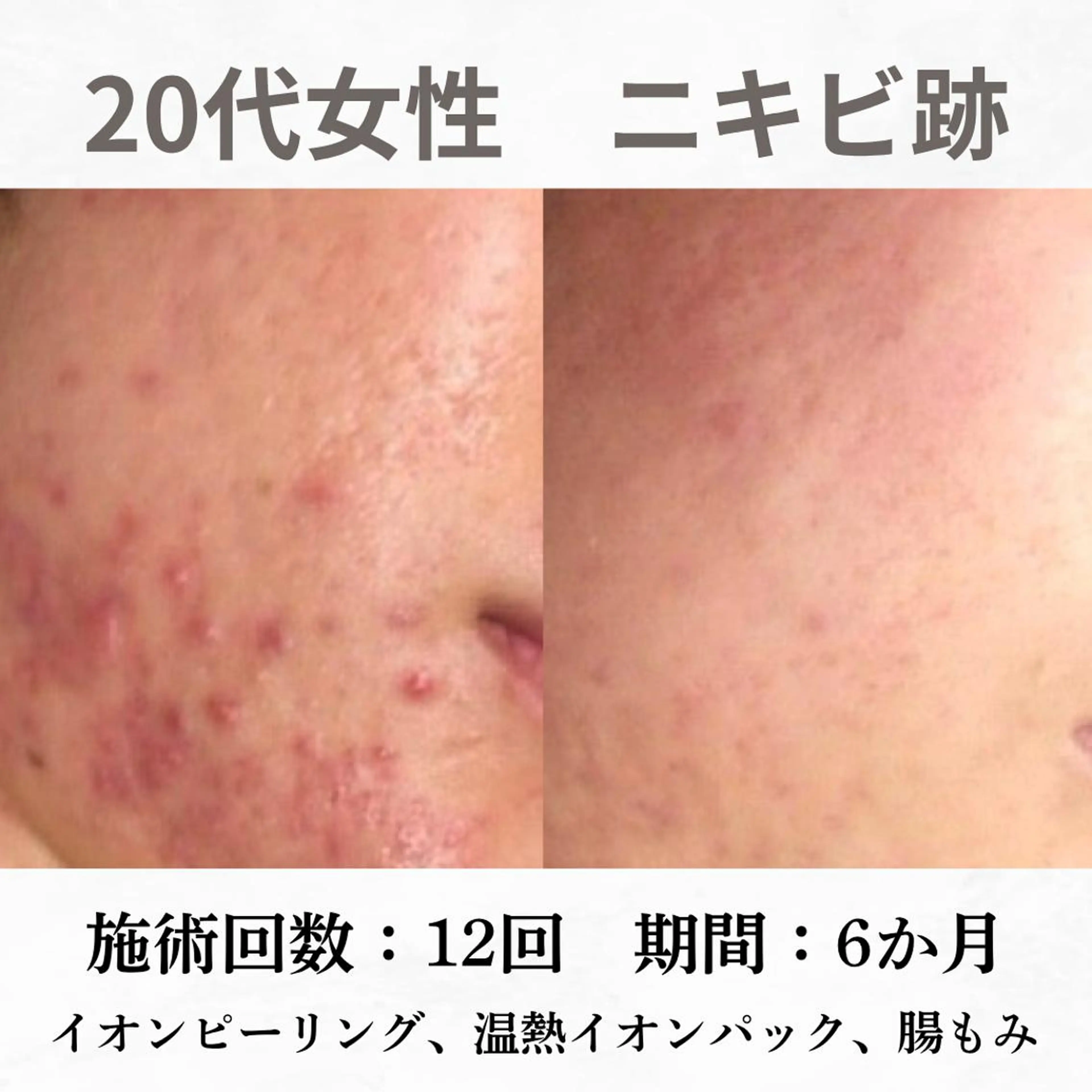 重度ニキビ専門🌷 ダウンタイムなしのエステ・リラクイメージ