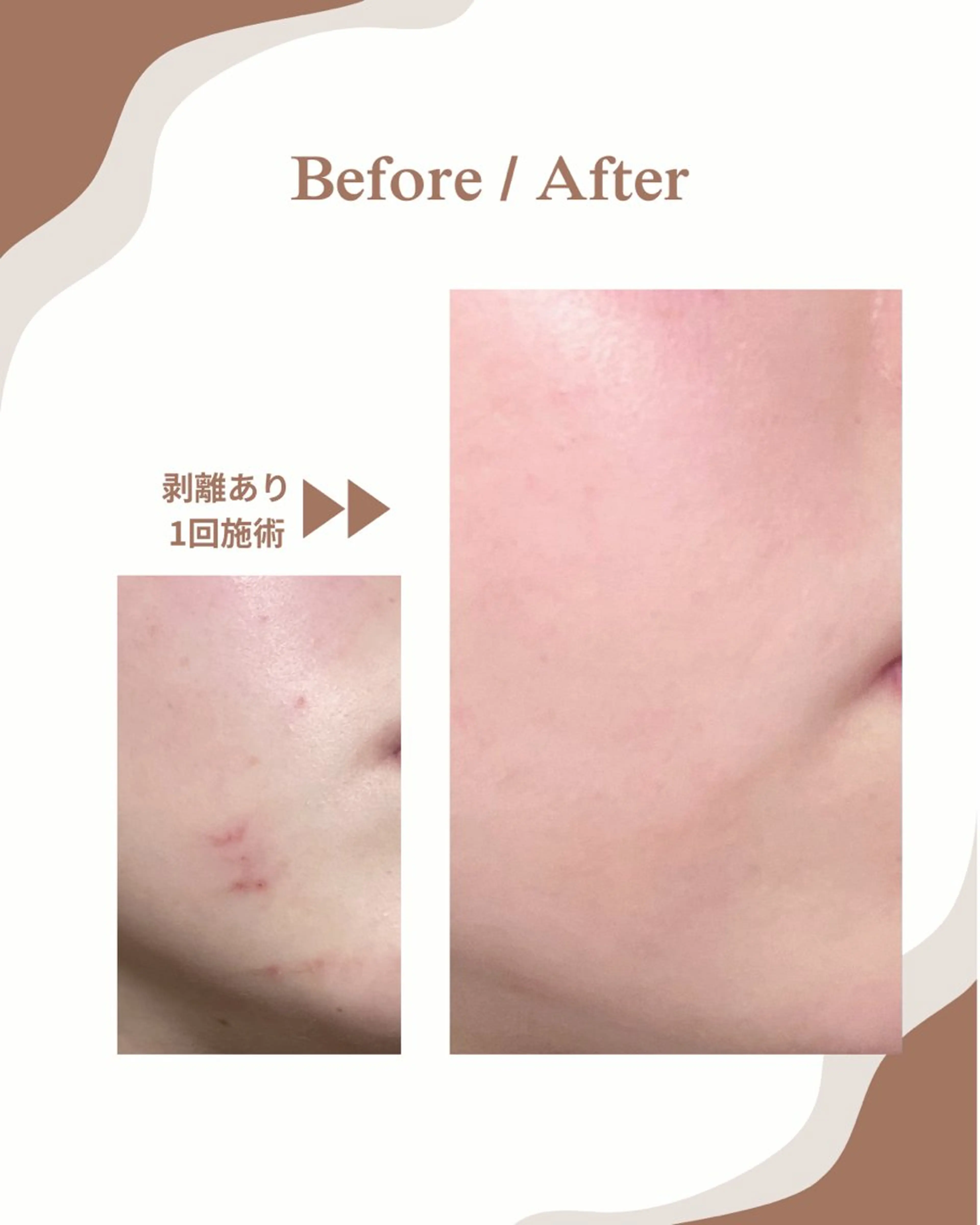 エステ myherb所属・ニキビ肌改善サロン myherb🌿のエステ・リラクイメージ