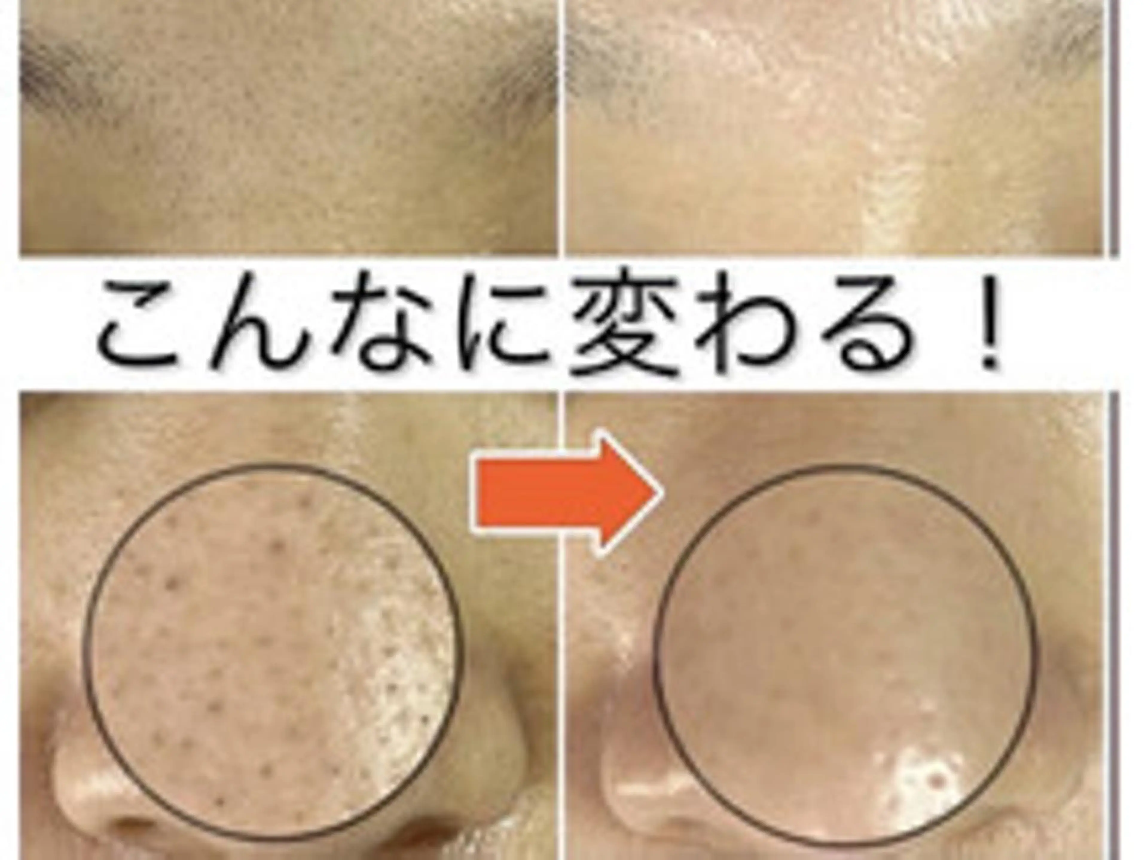 【初回限定】通常\¥6200⇒モニター価格\¥4900【ツヤ肌・毛穴・にきび】ハイドラフェイシャルの写真