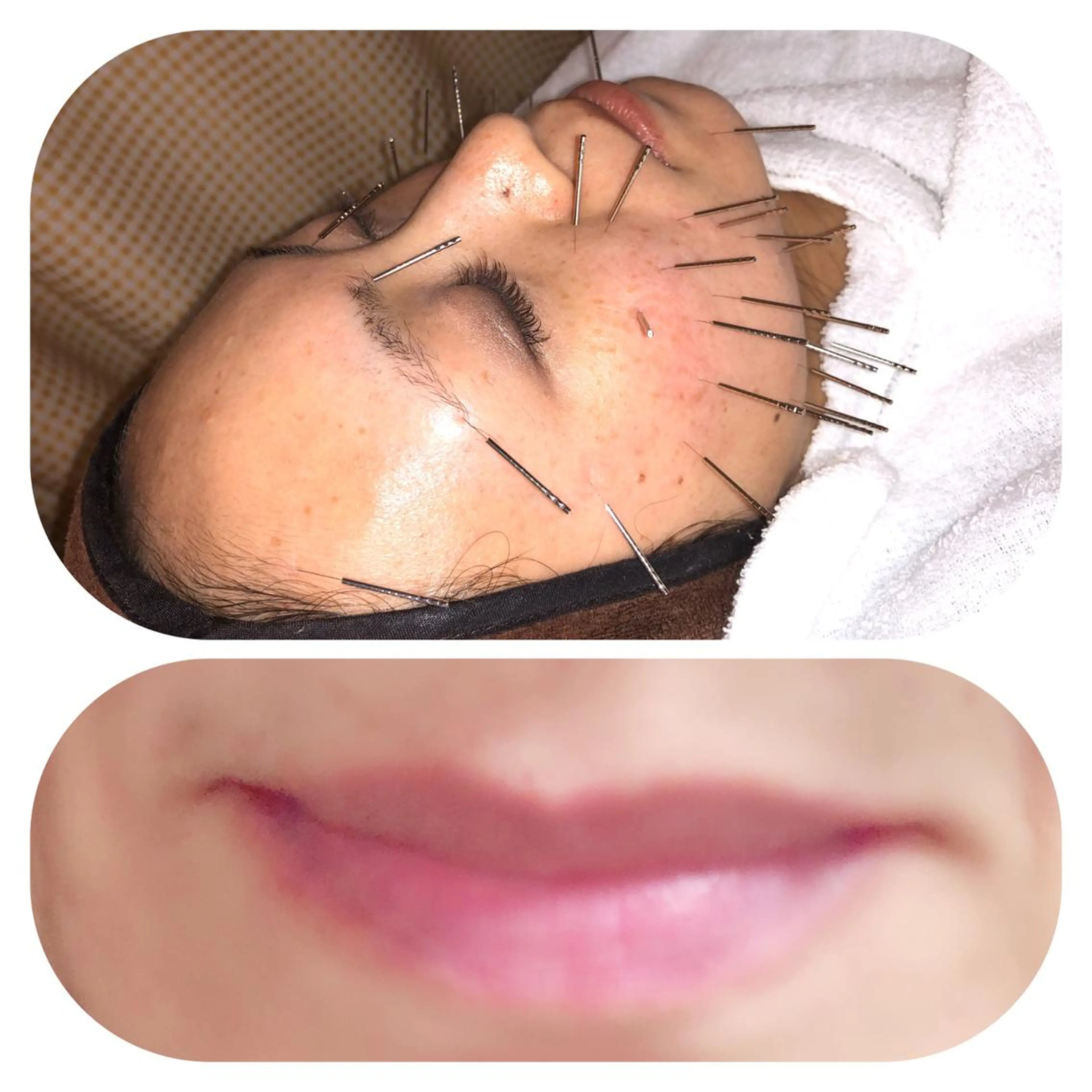 人気の💋🌟^_^🌟美容鍼90分＋プルプルリップエステ💋の写真