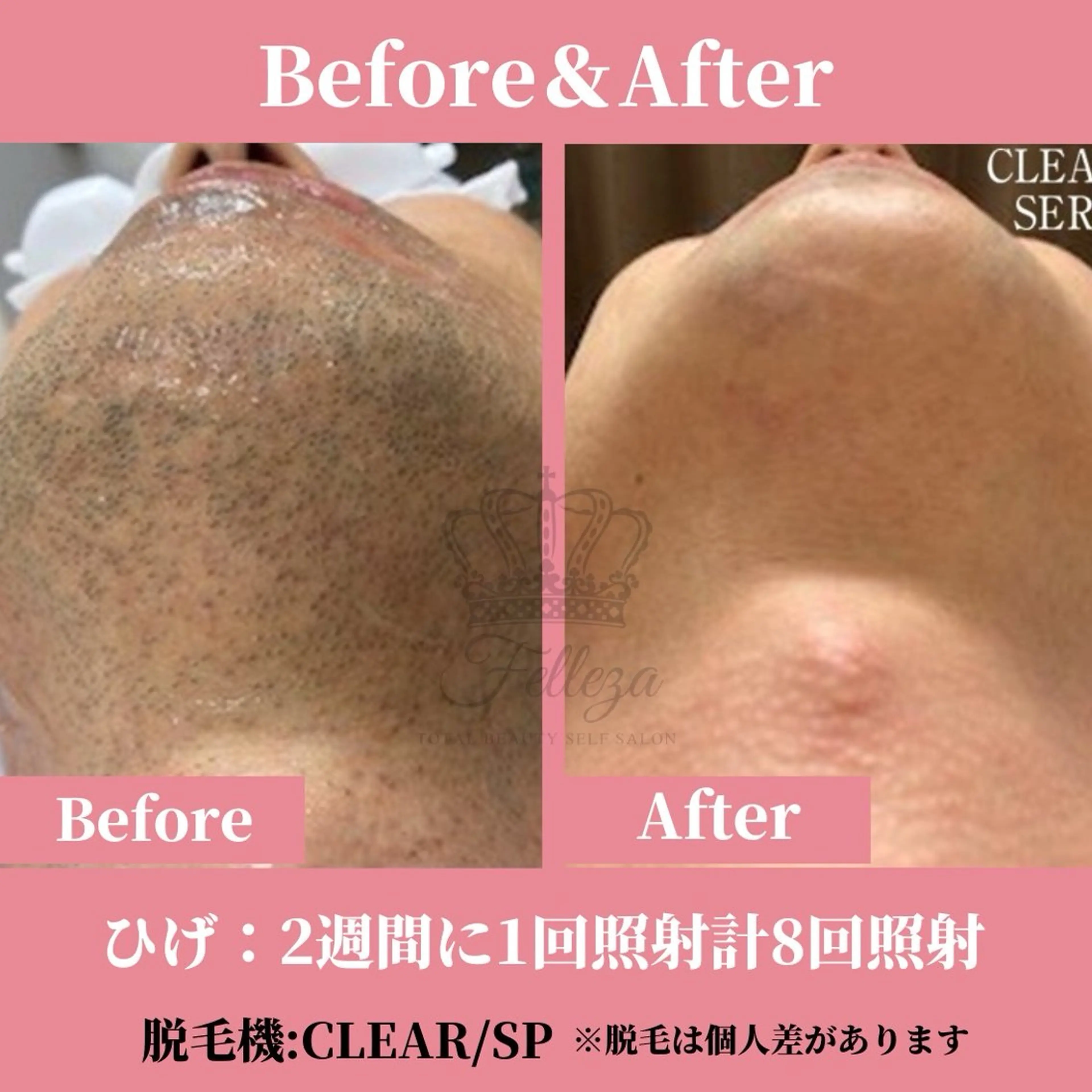 メンズ 有人型セルフサロン 脱毛／痩身／美顔のその他イメージ