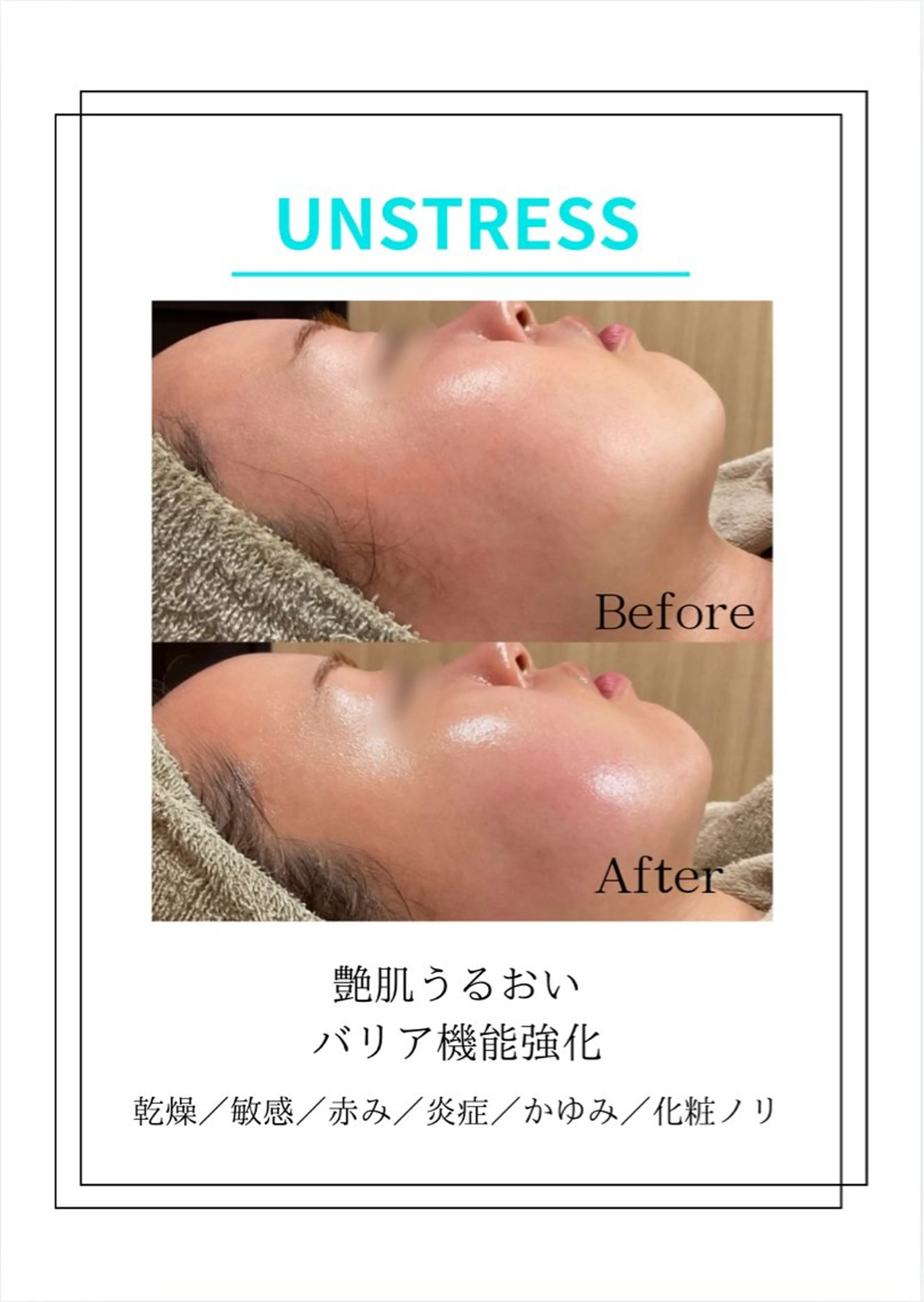 アンストレス乳酸菌ピーリング【乾燥/敏感肌】¥16,500→¥11,000 水分、艶肌トリートメントの写真