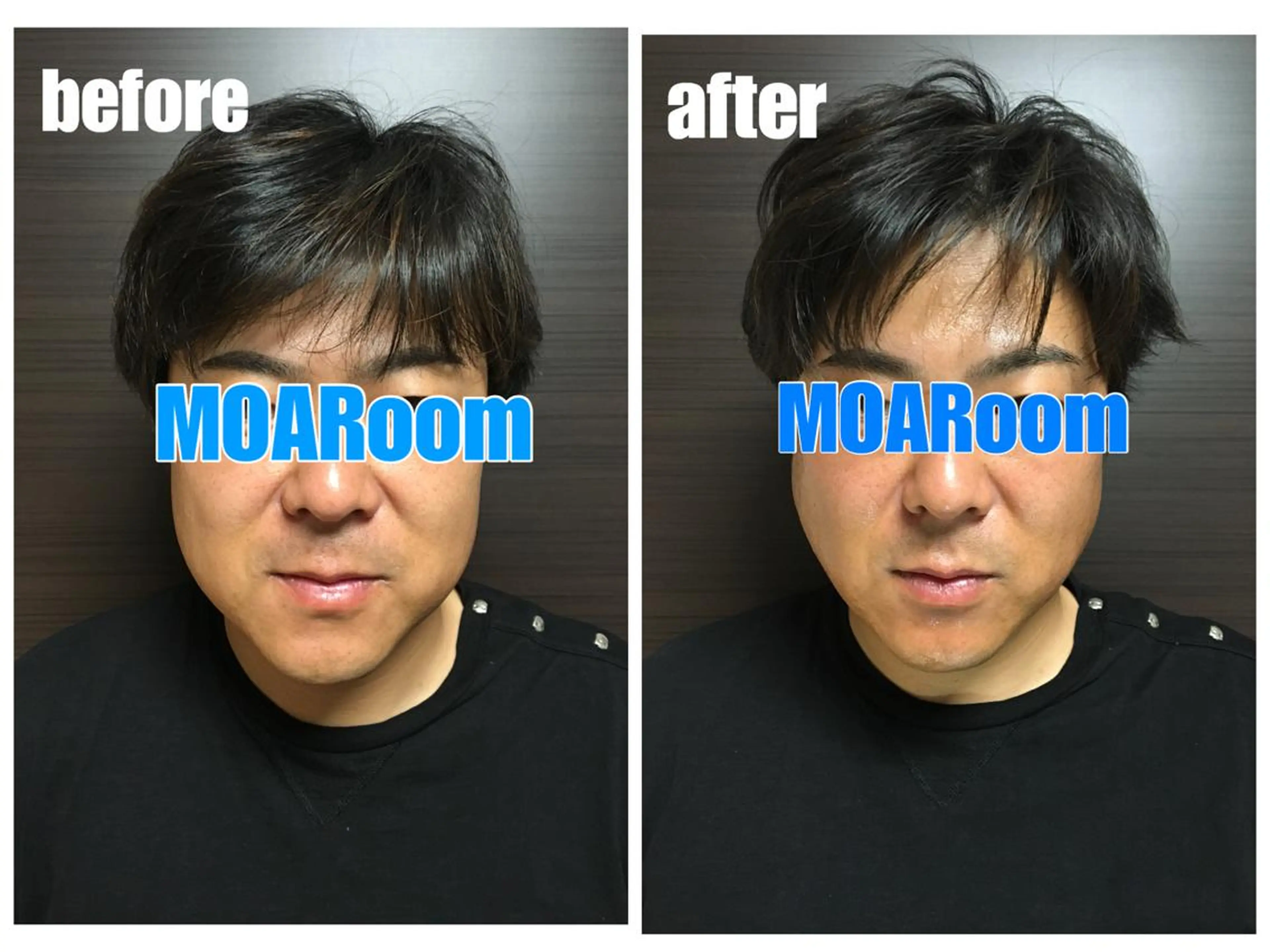 ２８日1回☆男の肌質改善☆ヒト由来幹細胞培養液フェイシャル60分の写真