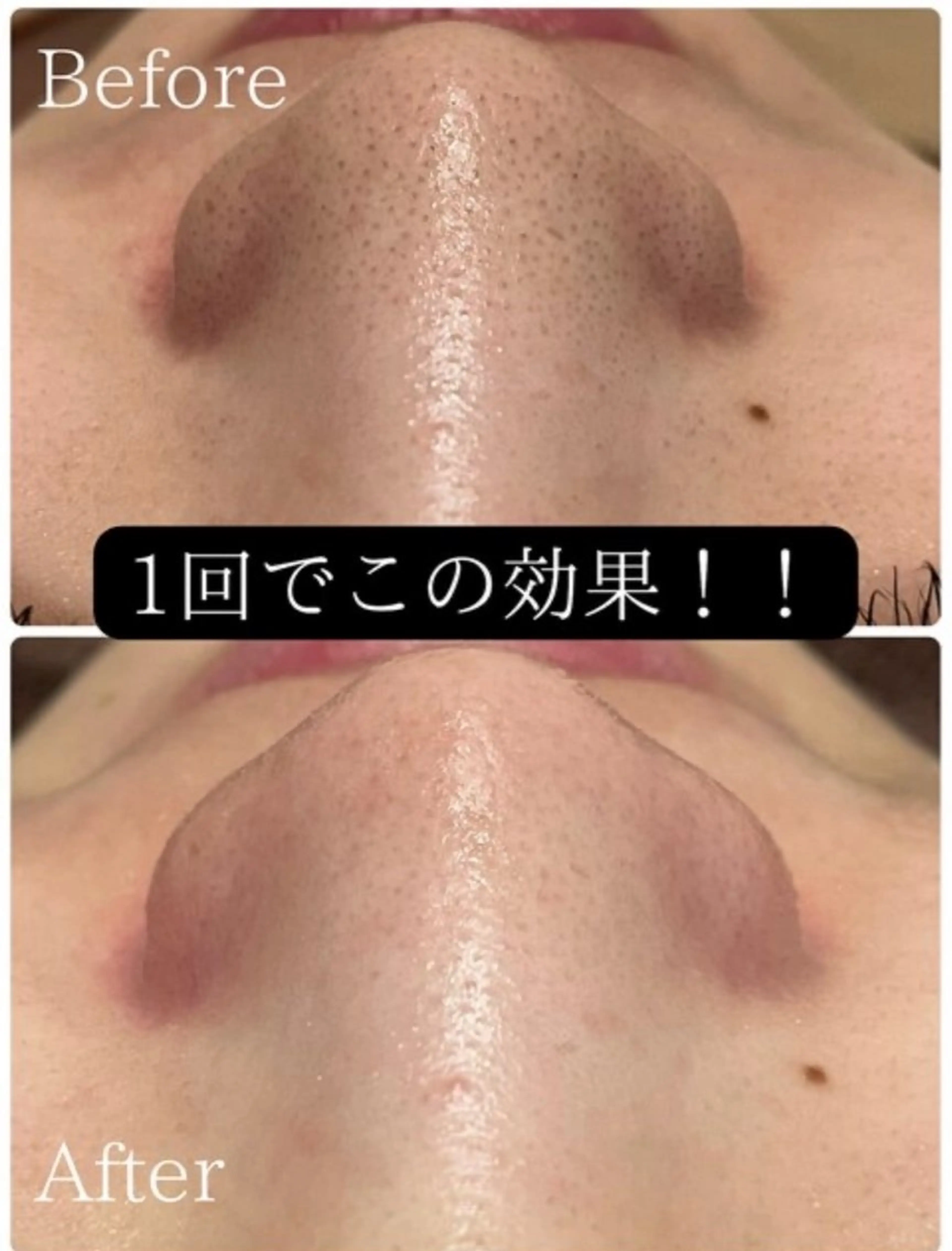 導入記念価格！鼻の黒ずみ改善！！全顔ハイドラ毛穴洗浄！※当店のハイドラ毛穴洗浄が初めての方限定の写真