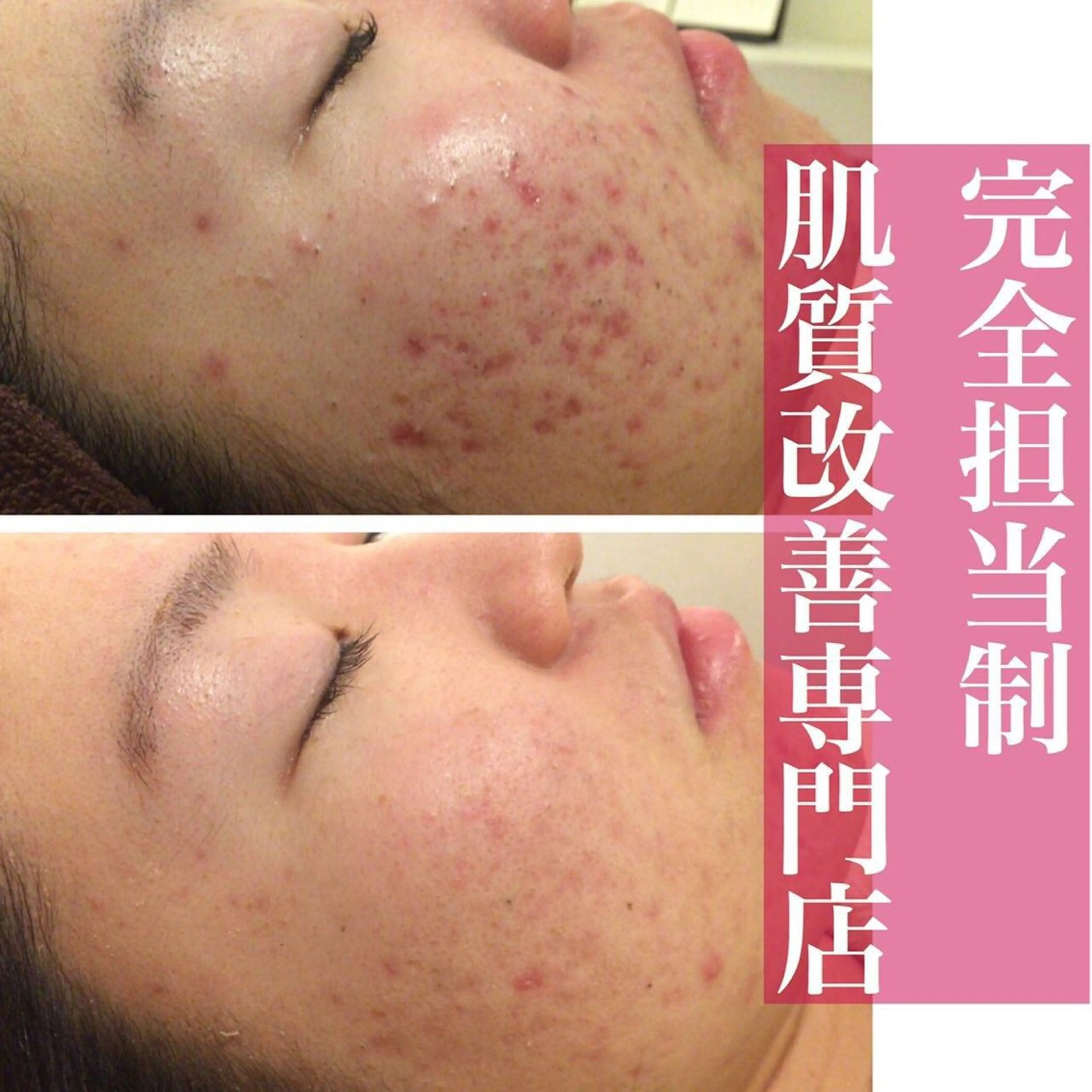 ニキビ跡改善専門🔥 医療にはできない改善のエステ・リラクイメージ