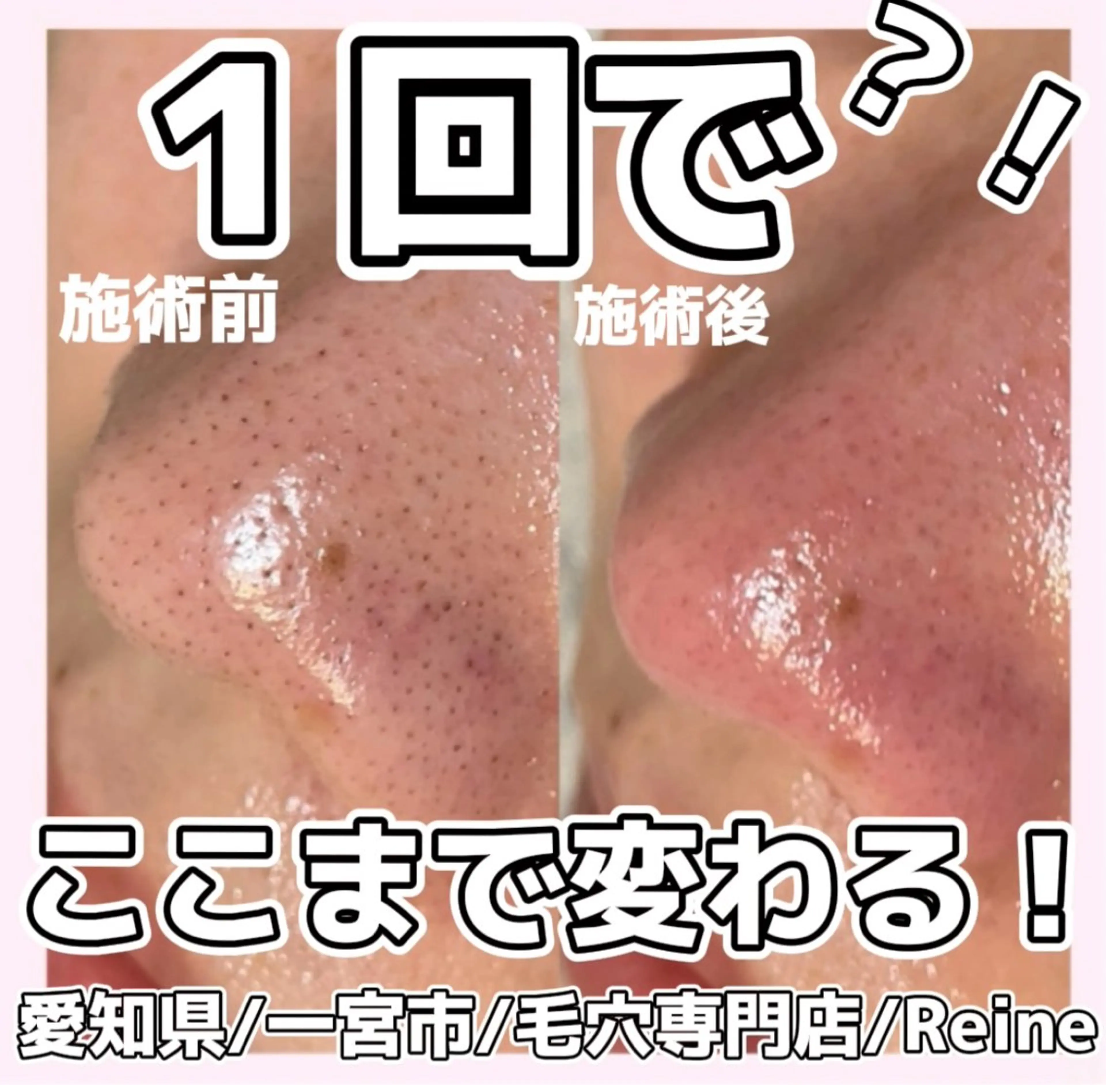 エステ Reine BeautySalon所属・毛穴/シミ肝斑/脱毛 横山梨里のエステ・リラクイメージ