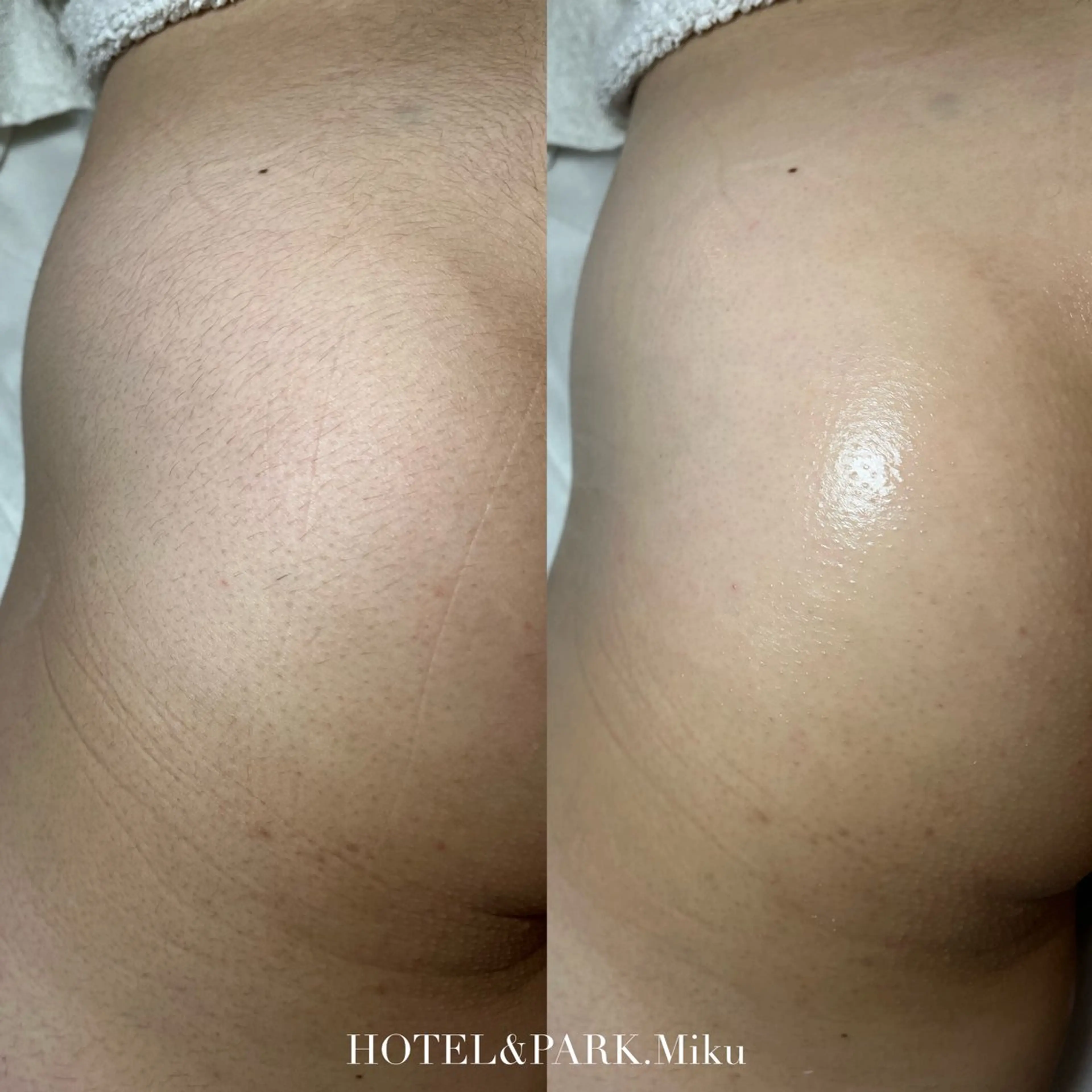 HOLIDAY SALE❄️☃️40%OFF❤️【VIO+(ヒップorお腹)ワックス脱毛】の写真