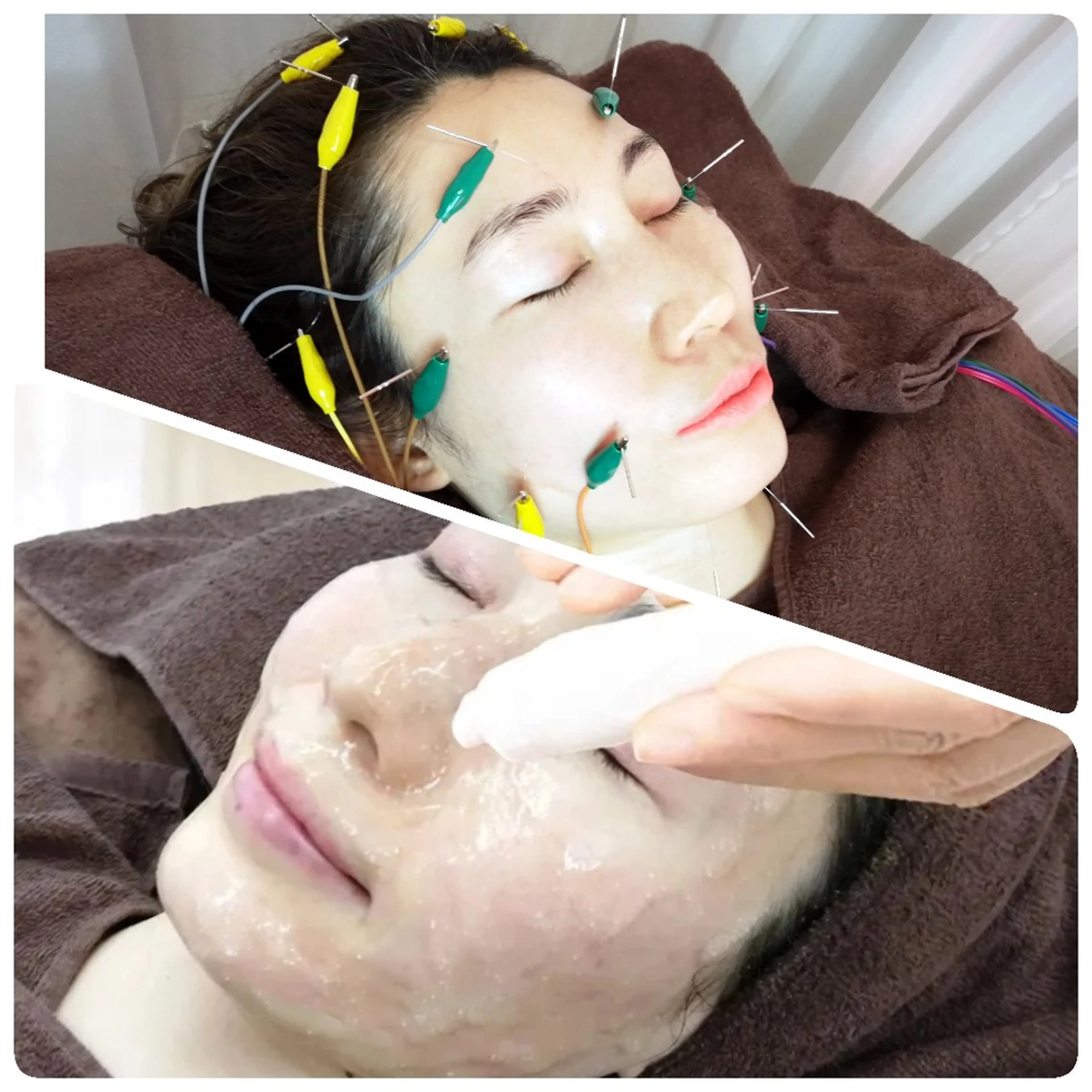 【いちご鼻・角栓・小顔】毛穴洗浄ハイドラフェイシャル💧+20ヶ所電気美容鍼🪡⚡【ニューハーフ鍼灸師の最強肌管理🌹】の写真