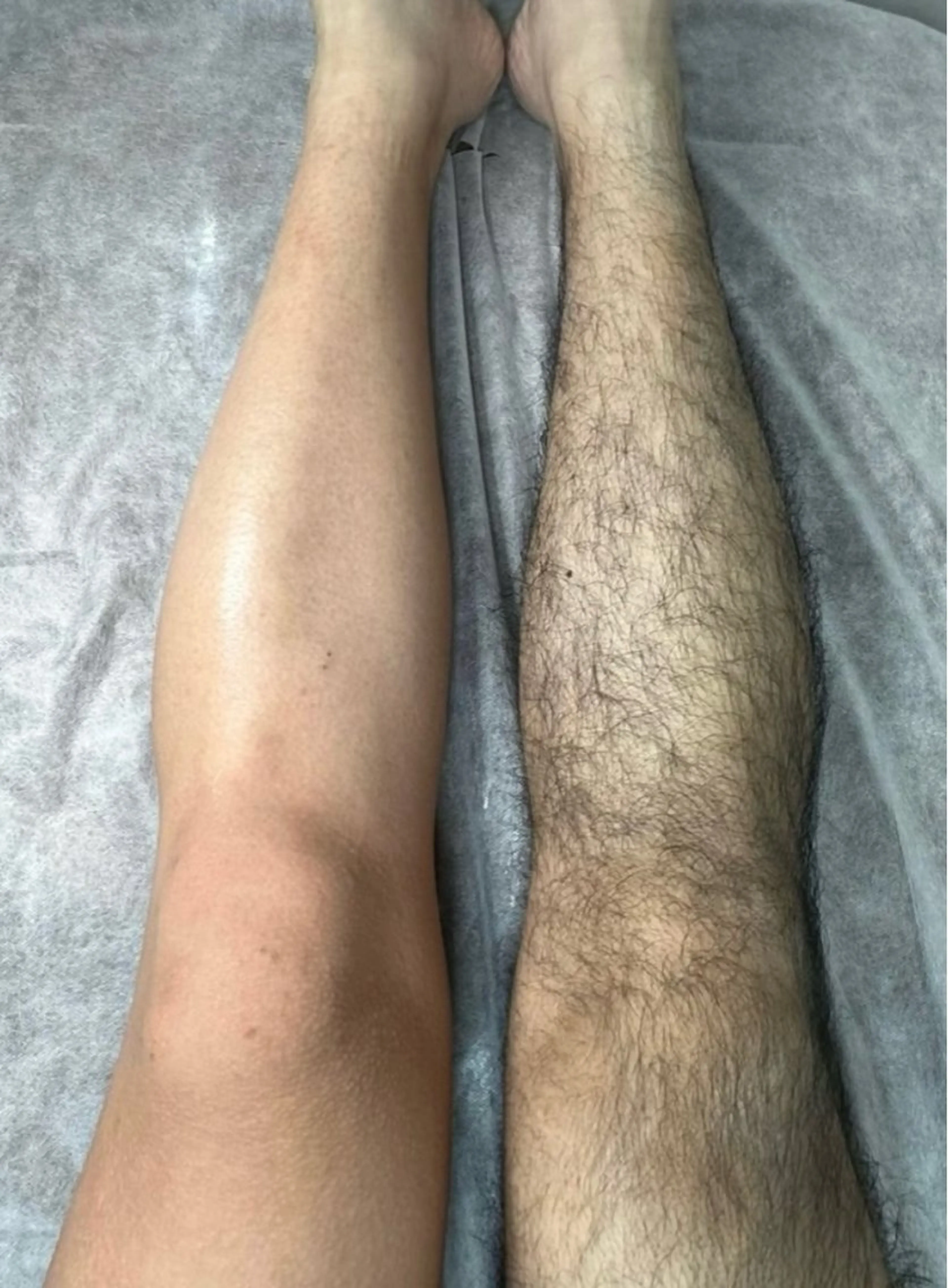 🌟男性🌟【魅せる脚.腕】両足両腕ブラジリアンワックス脱毛の写真