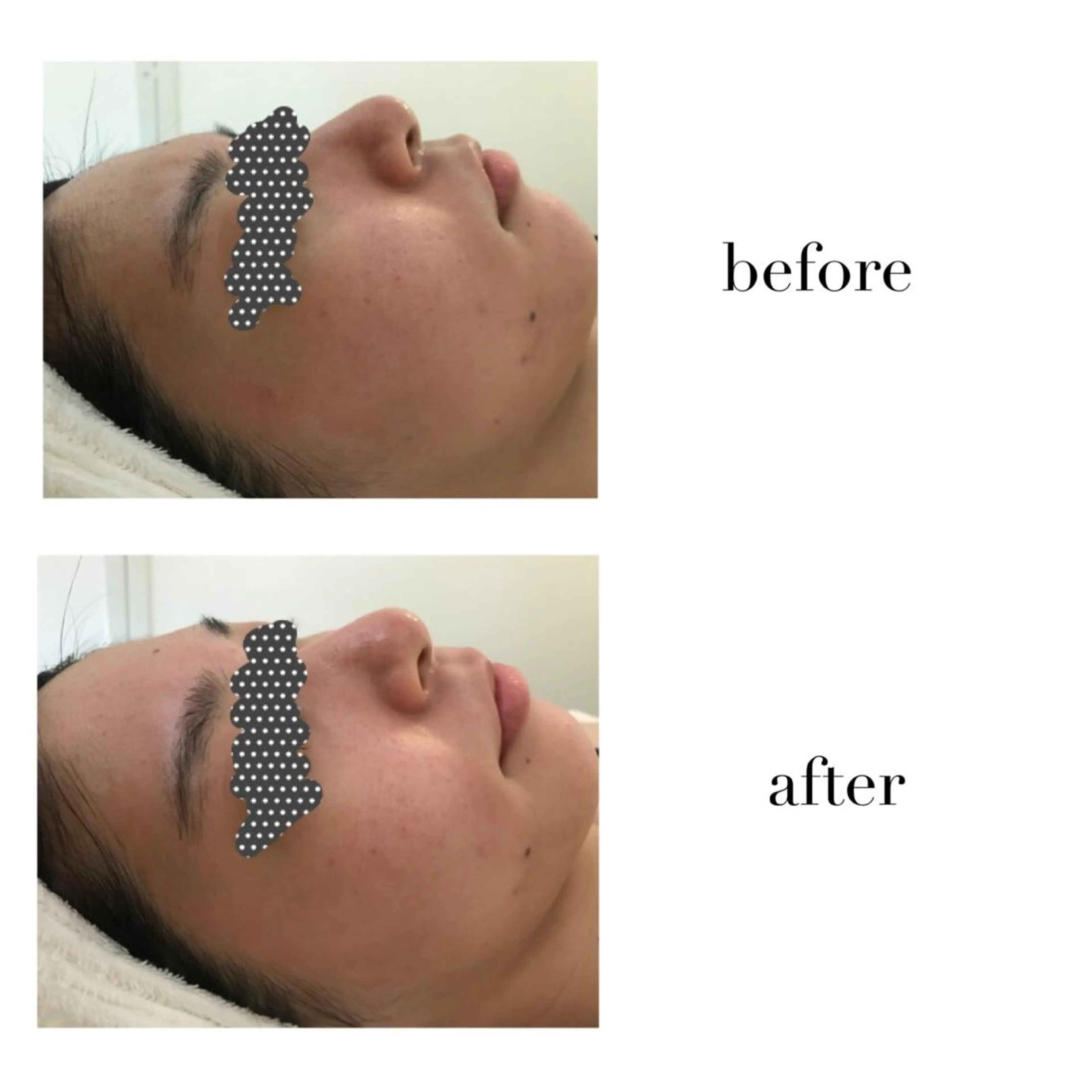 エステ リラク 毛穴/ピーリング ララピール/POLAのエステ・リラクイメージ