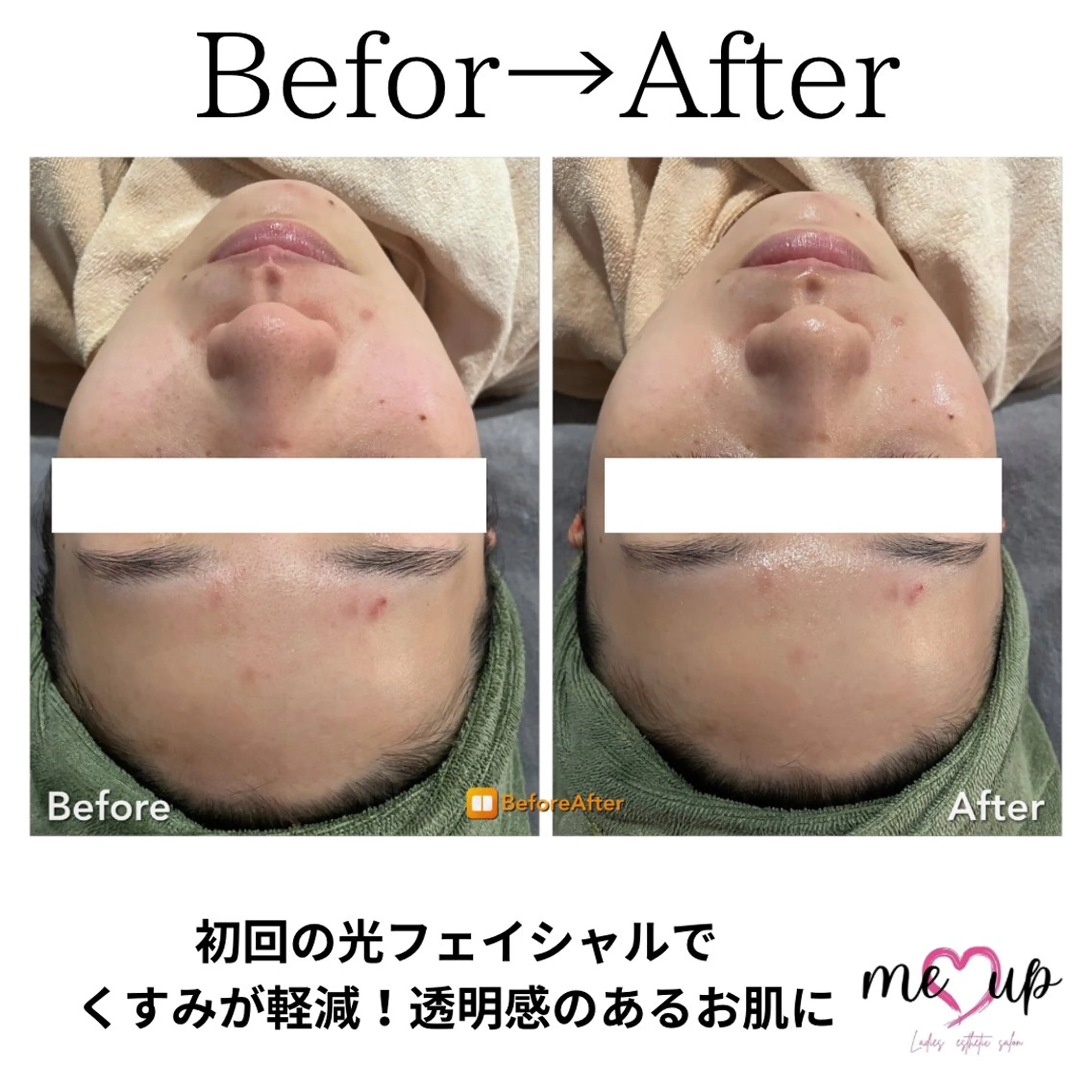 エステ Meupニキビ専門店 背中/ハーブ/肌管理のその他イメージ