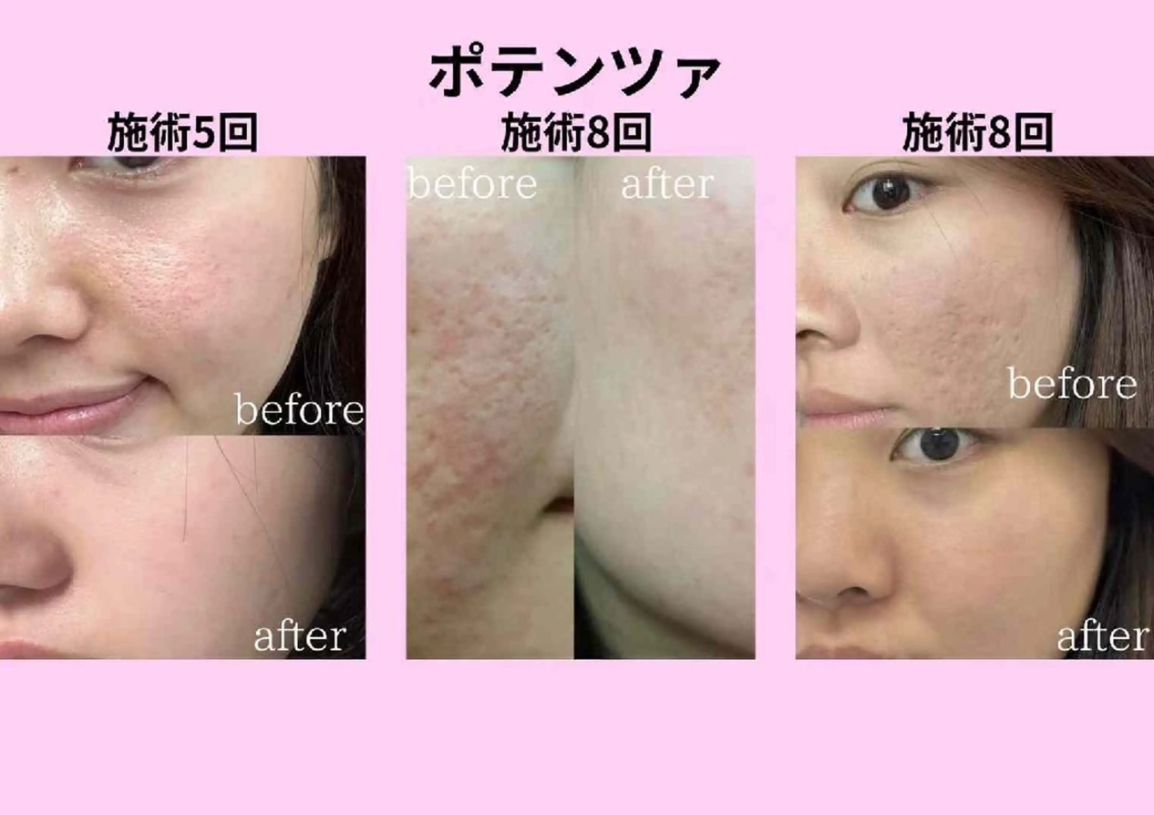 aliaハイフ&水光ジェットサロン所属・aliaハーブ水光店 エステティシャン募集のエステ・リラクイメージ