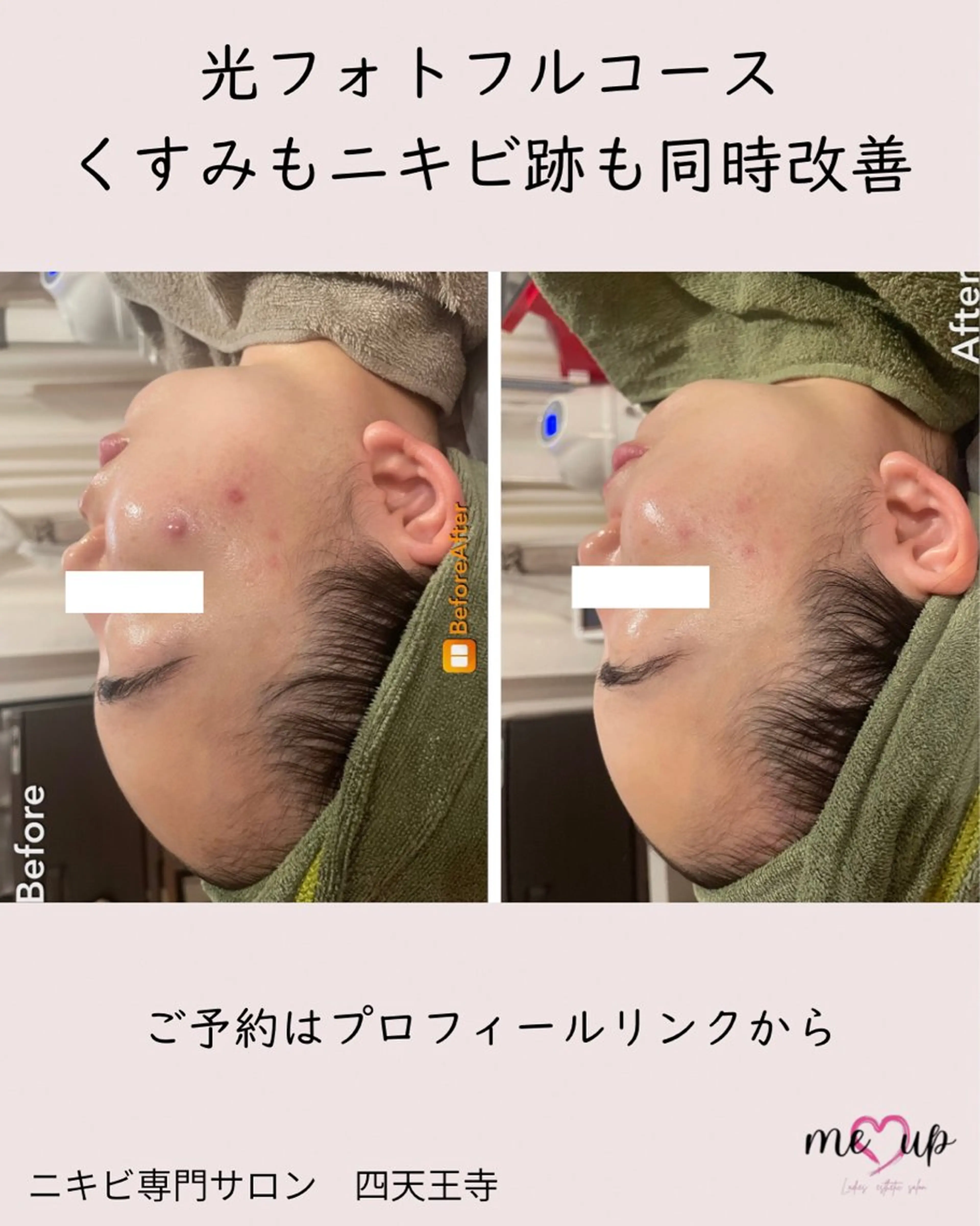 エステ Meupニキビ専門店 背中/ハーブ/肌管理のその他イメージ